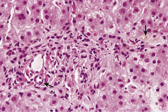 Fig. 13.8, Paucity of bile ducts in childhood.