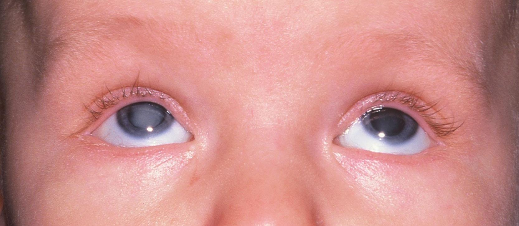 Fig. 35.1, Nuclear cataracts. This 4-month-old child presented with nystagmus and bilateral nuclear cataracts. His parents had noted that he would stare at room lights. After bilateral lensectomies and contact lens correction, his nystagmus improved. After long-term follow-up, his best-corrected visual acuity is 20/25 when both eyes are tested together, but 20/50 when each of his eyes is tested separately due to latent nystagmus.