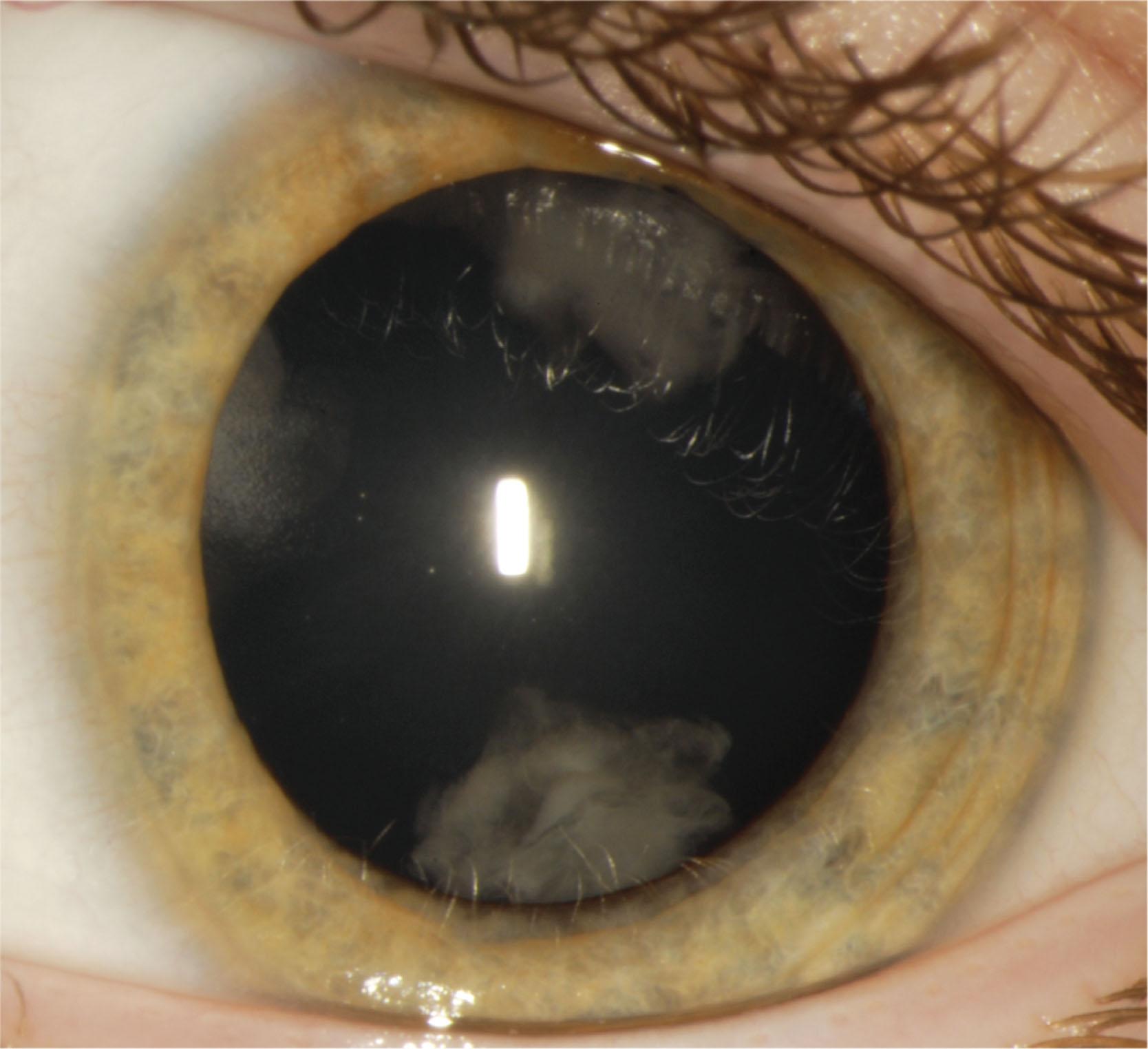 Fig. 35.11, Wedge-shaped cataracts. Peripheral wedge-shaped cataracts in a child with autism. Similar appearing cataracts occur in children with Stickler syndrome.