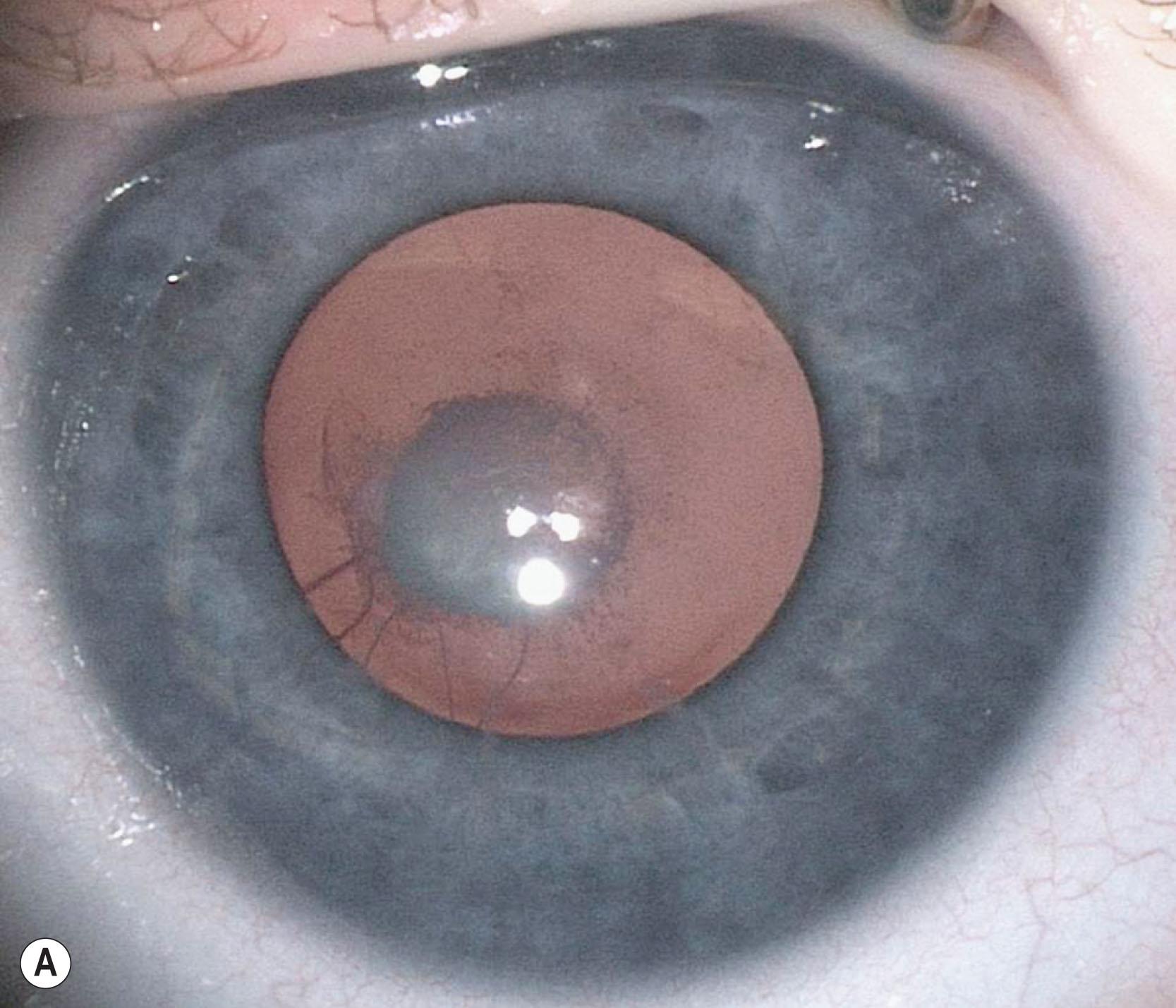 Fig. 35.12, Persistent fetal vasculature (PFV). (A) Mild PFV with hyaloid vessels attached to retrolenticular plaque. (B) Mild PFV with prominent iridohyaloid vessels and a large retrolenticular plaque. (C) PFV with a dense cataract and hairpin loops. (D) Severe PFV with stretching of the ciliary processes nasally and a dense cataract.