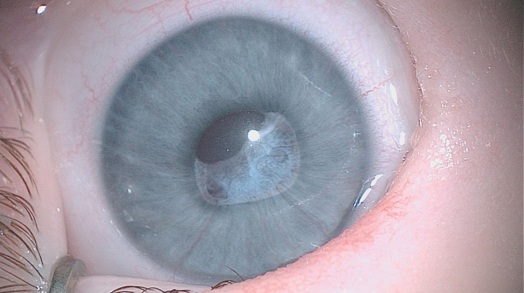 Fig. 35.13, Anterior persistent fetal vasculature. Vascularized pupillary membrane and prominent iridohyaloid vessels in an infant with microcoria.