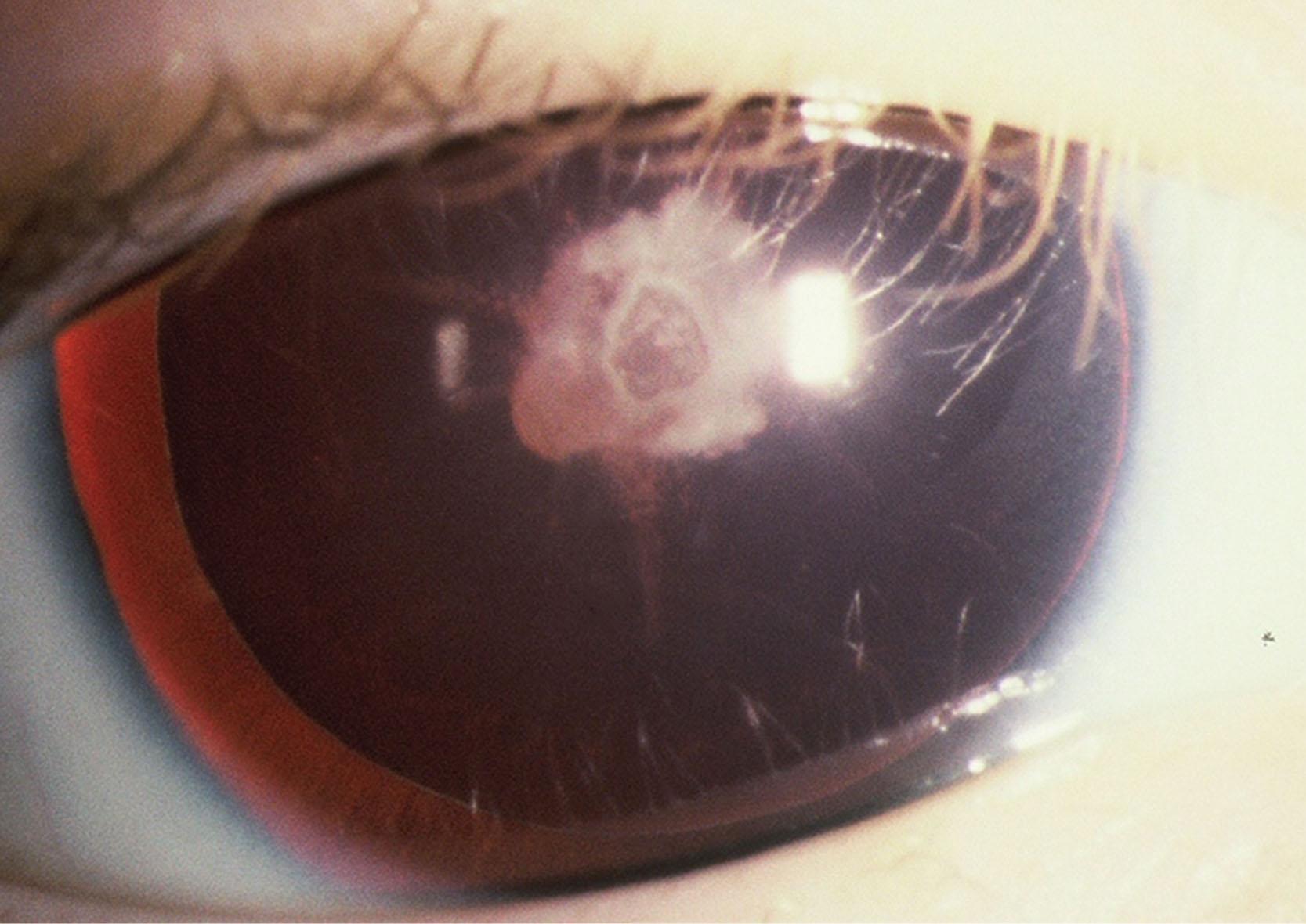 Fig. 35.14, Aniridia. Polar cataracts in a child with aniridia. Macular hypoplasia is the limiting factor for vision in this eye rather than cataract.