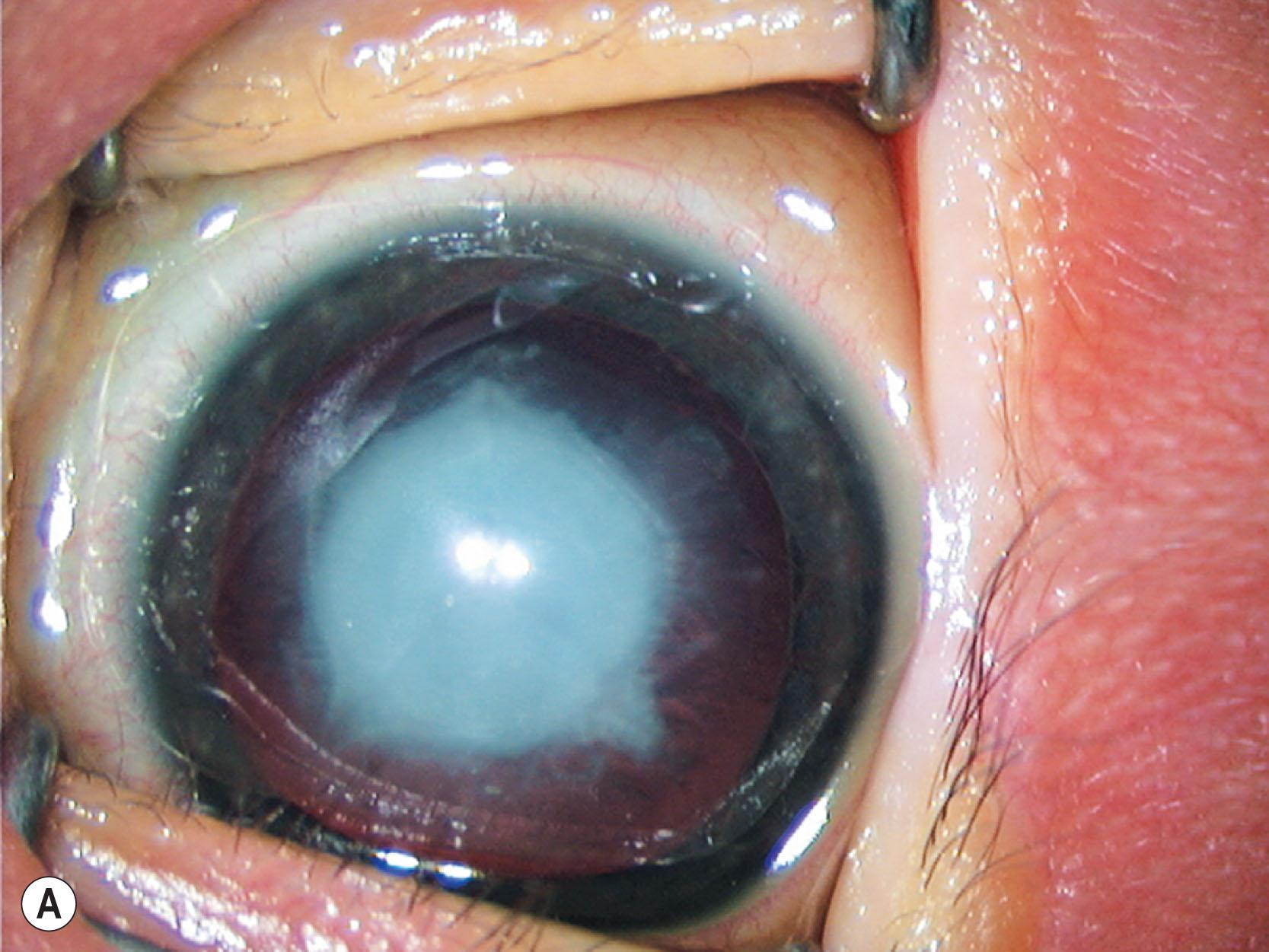 Fig. 35.15, Trisomy 21. Nuclear cataracts in right (A) and left (B) eyes of an infant with trisomy 21.