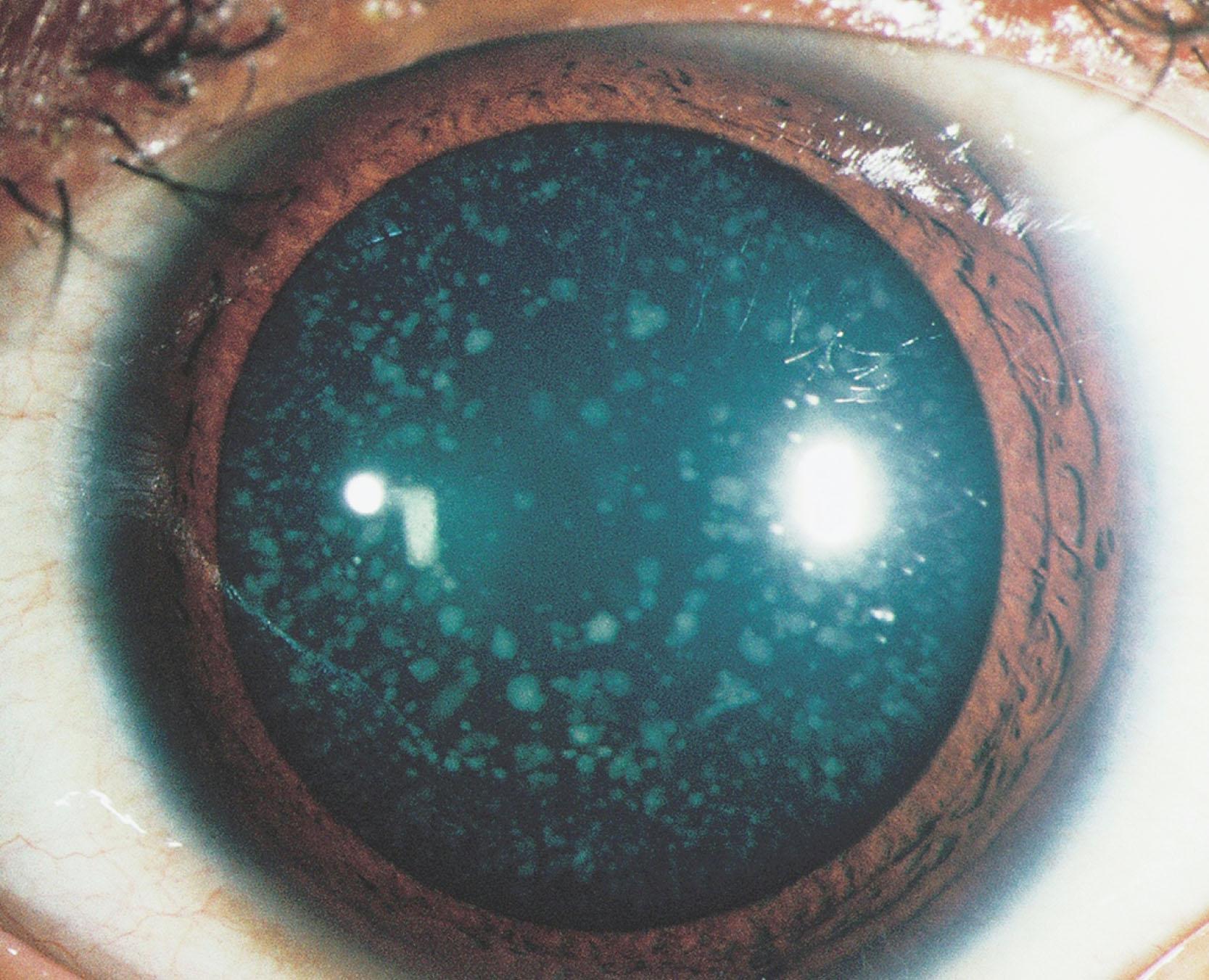 Fig. 35.16, Trisomy 21. Cerulean cataract in a teenager with trisomy 21. A similar cataract was present in the fellow eye. Visual acuity was normal.