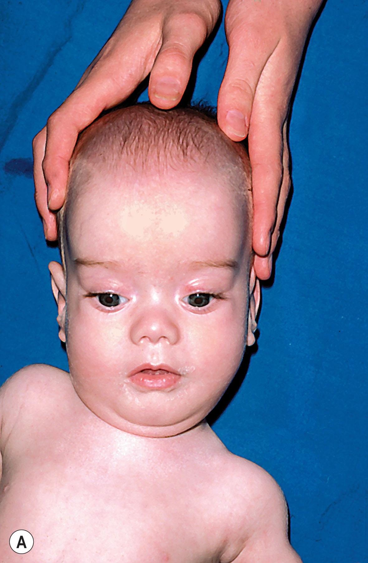 Fig. 35.17, Lowe syndrome. (A) “Chubby” cheeks and rounded forehead. Dense nuclear cataracts in right (B) and left (C) eyes.