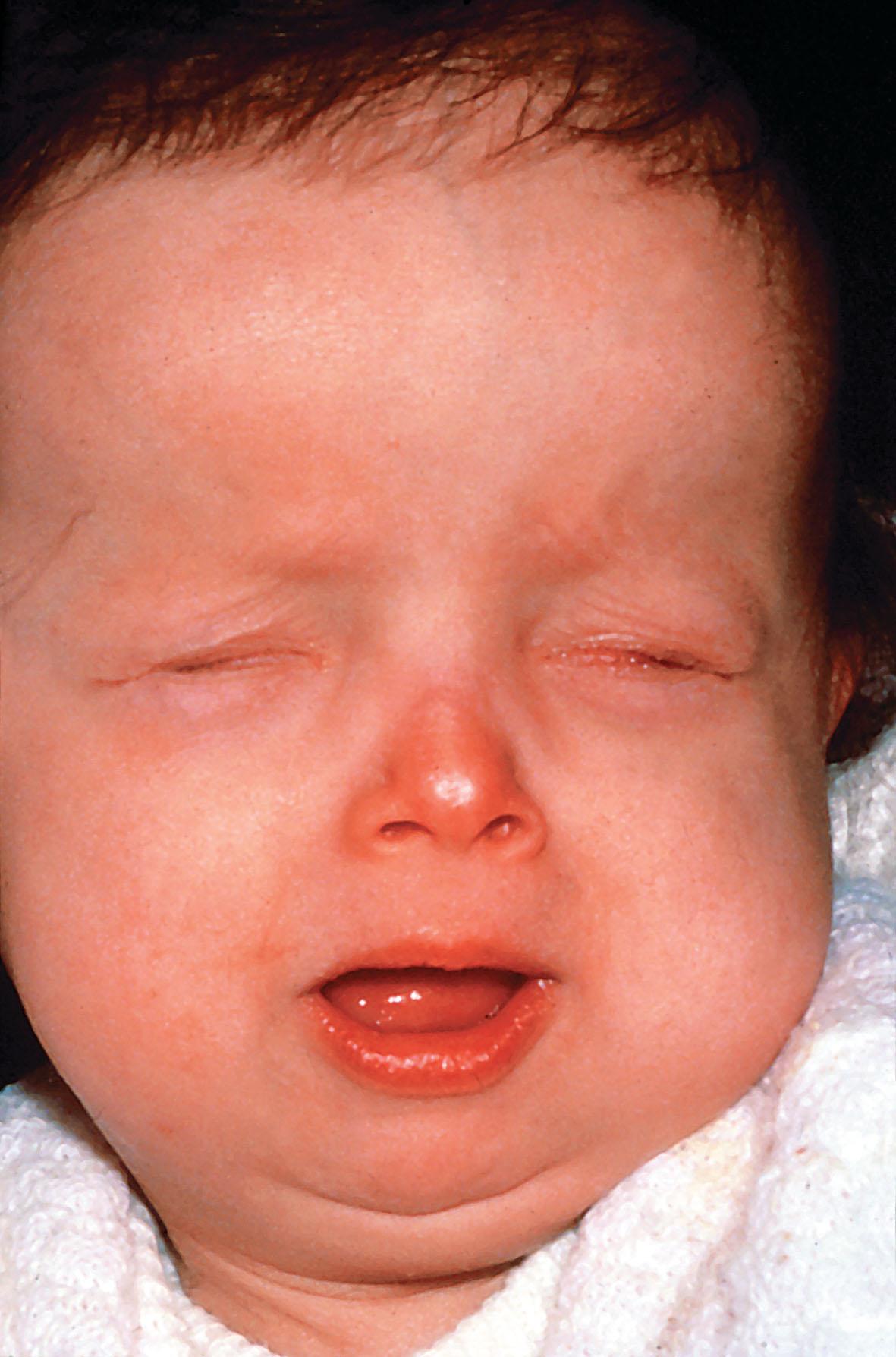 Fig. 35.18, Hallermann–Streiff–François syndrome. Note the receding hairline and the small, red, upturned nose.