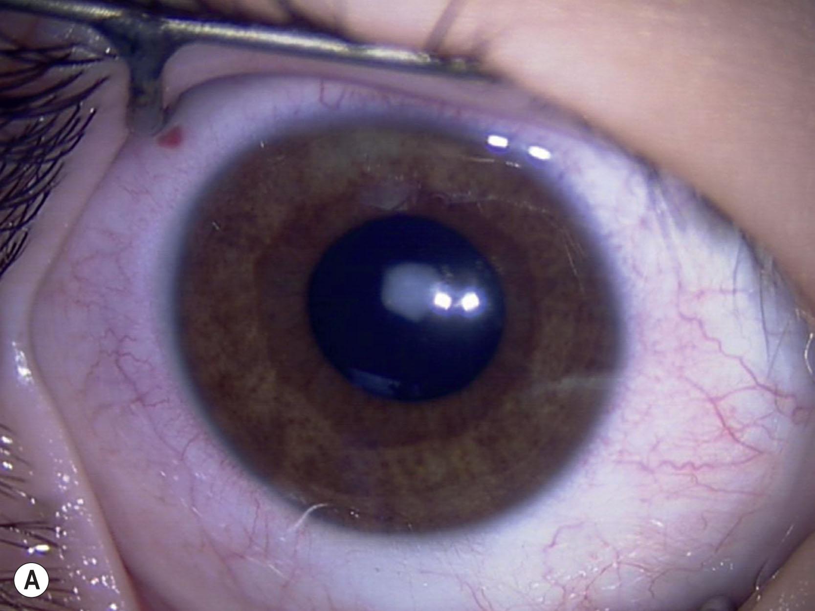 Fig. 35.3, Anterior polar cataracts in the right (A) and left (B) eyes. The child's mother, sister, and brother also had bilateral anterior polar cataracts.