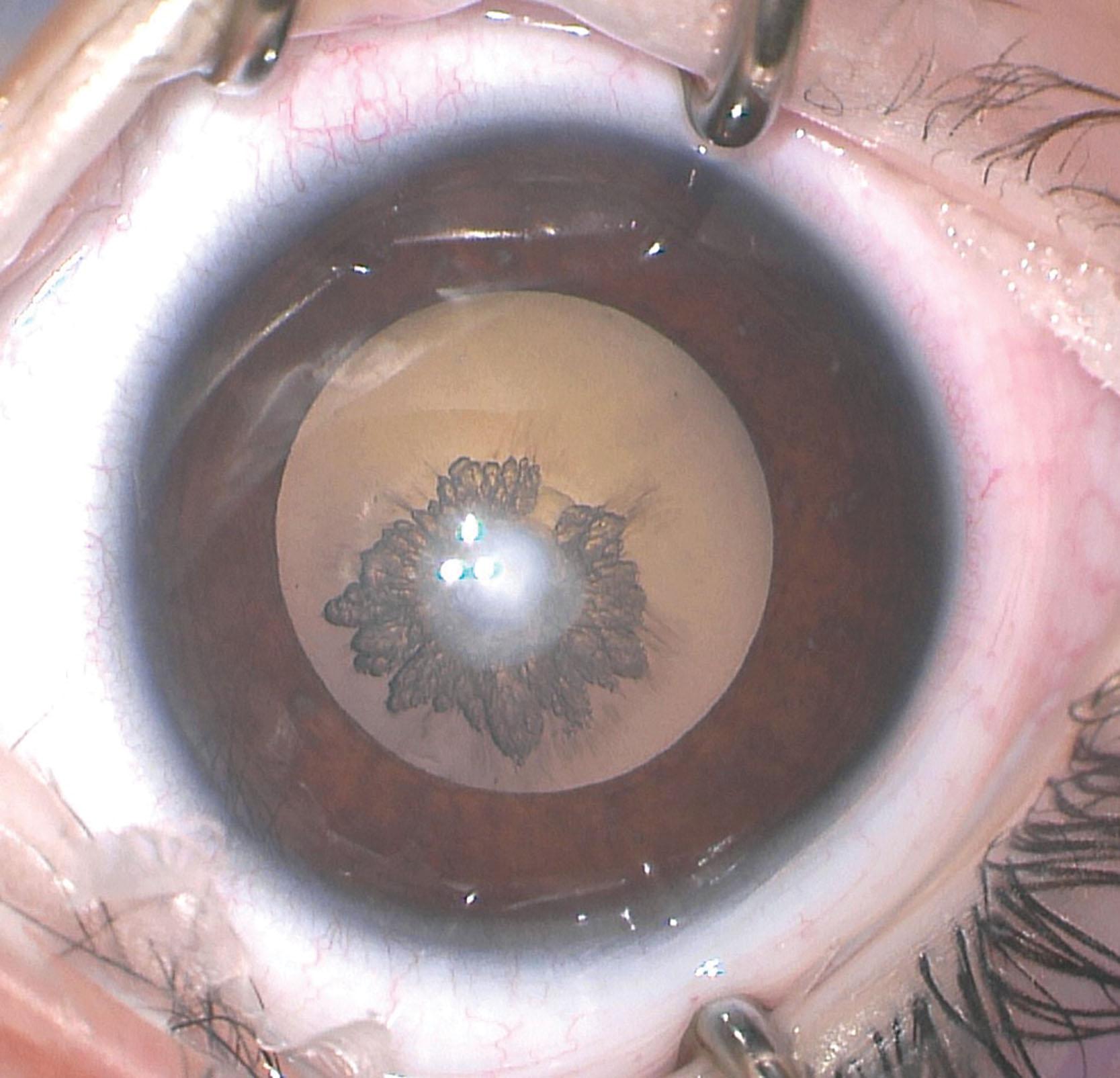 Fig. 35.4, Anterior polar cataract. At birth, this child was noted to have a 1 mm anterior polar cataract. The cataract gradually increased in size until it was removed at 5 months of age.