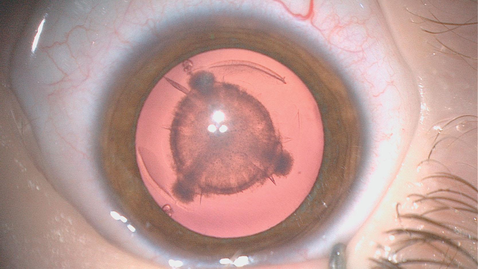 Fig. 35.5, Lamellar cataract.