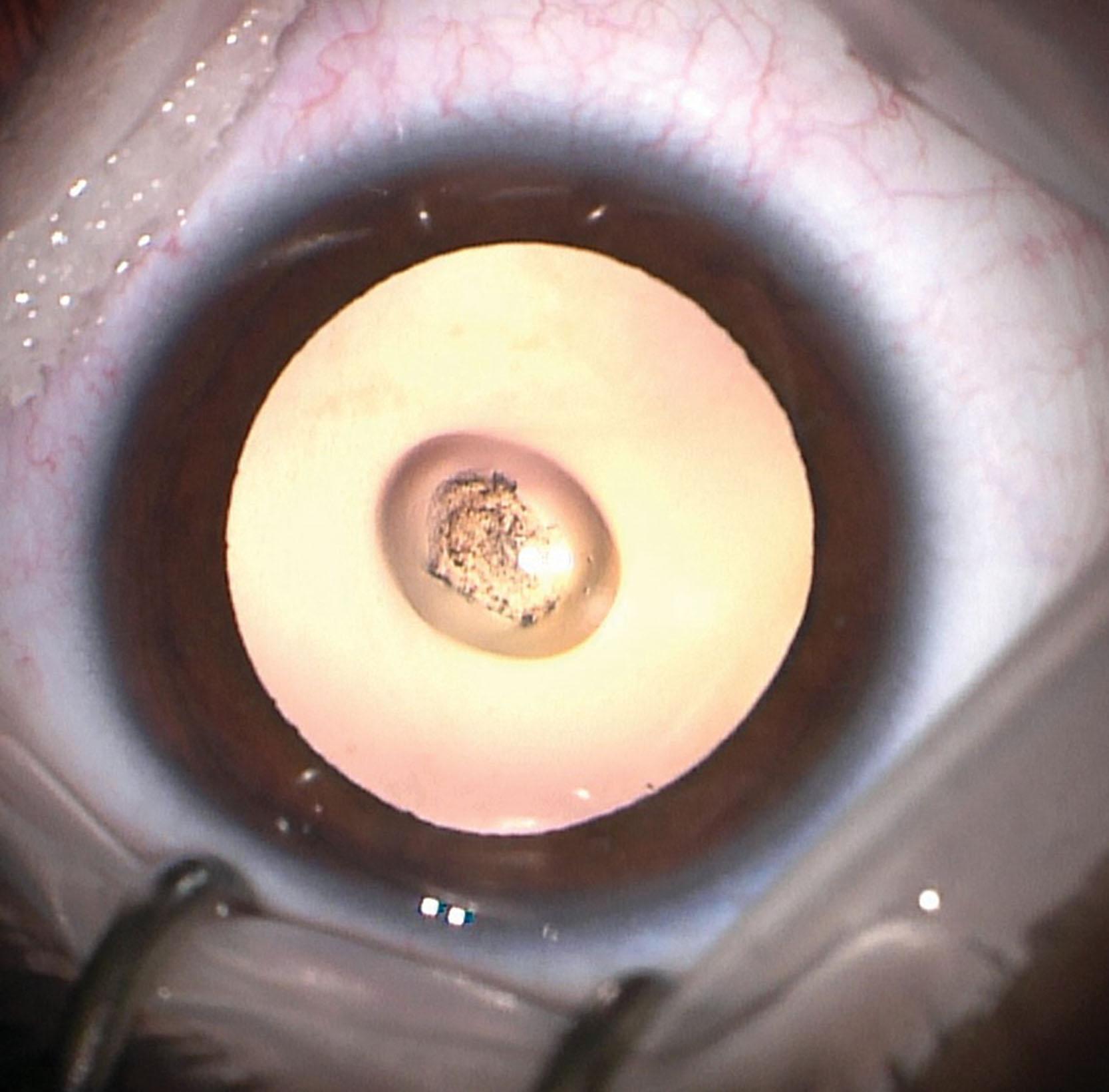 Fig. 35.6, Posterior lentiglobus.