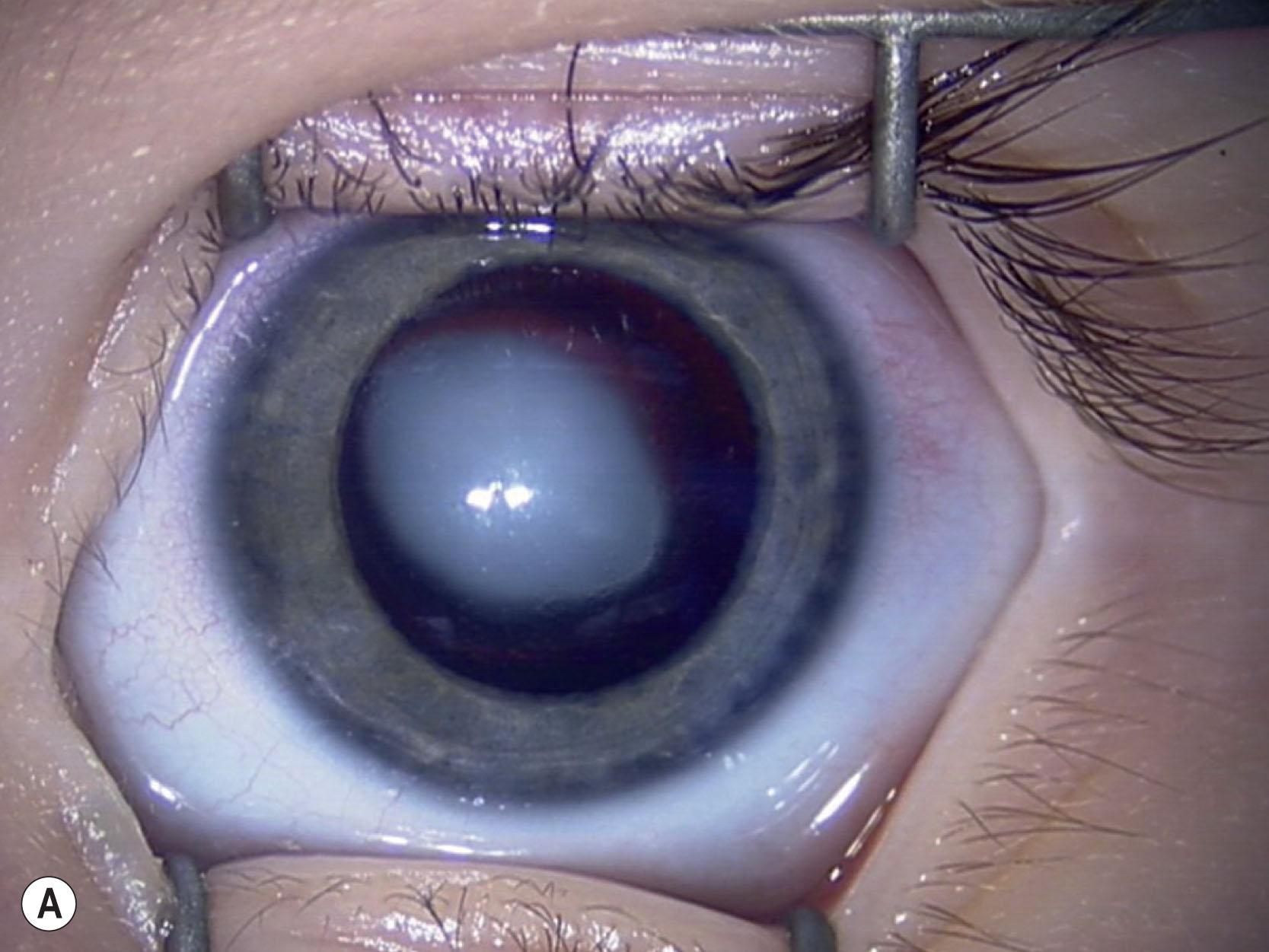 Fig. 35.7, Bilateral posterior lentiglobus. This 8-month-old child presented with lentiglobus in both eyes. (A) There is a dense cataract overlying the lentiglobus in the left eye. (B) The lens cortex is still clear over the lentiglobus in the right eye.