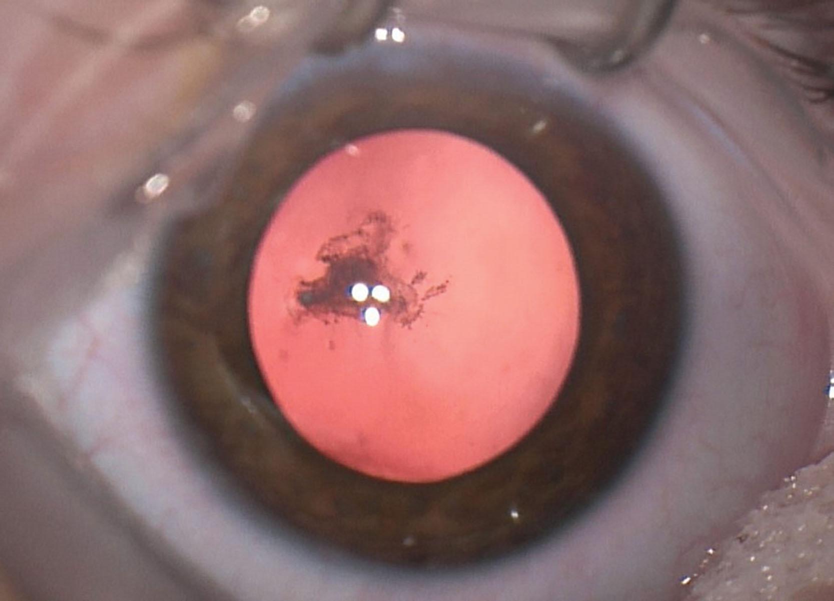 Fig. 35.8, Posterior polar cataract. At birth the child was noted to have a small cataract. Part-time patching of the fellow eye was initiated. She was followed closely for progression of the cataract. At age 12 months the cataract was noted to have increased in size and she started to object to patching of the fellow eye so a lensectomy was performed.