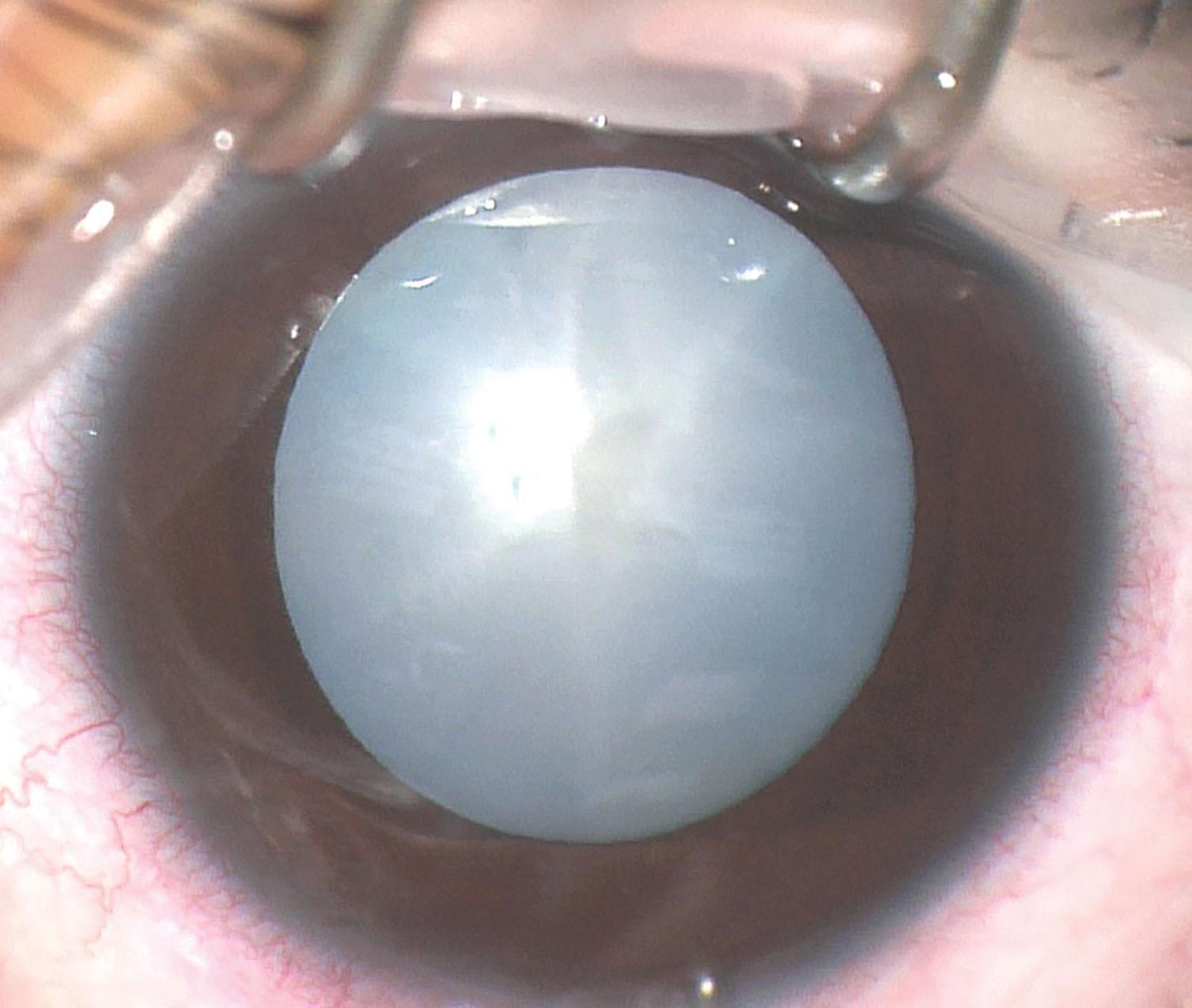 Fig. 35.9, Total cataract in an 8-year-old with Coats disease following multiple intravitreal injections of anti-VEGF inhibitors and corticosteroids.