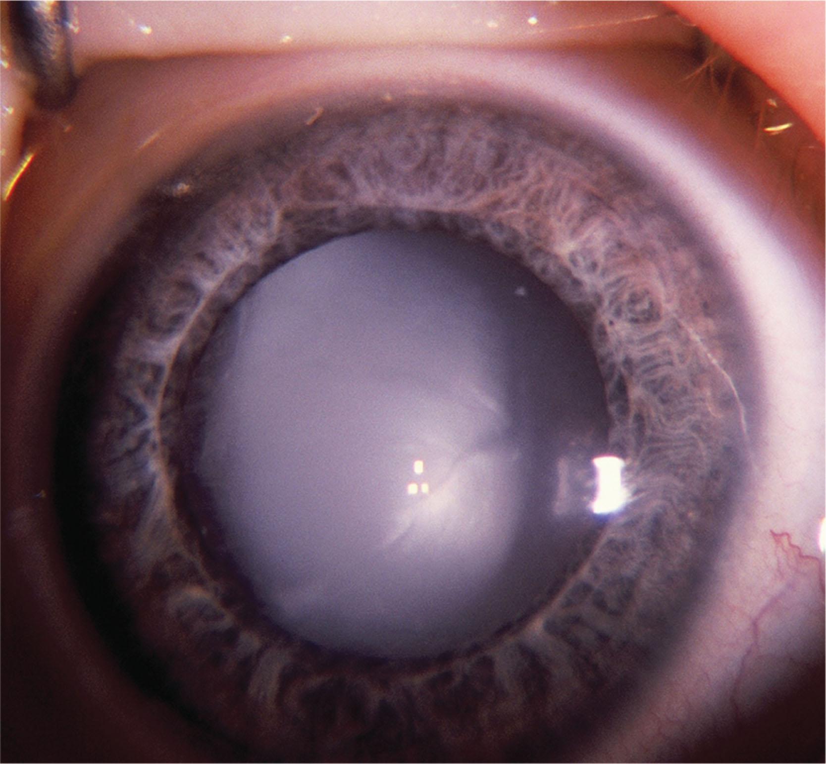 Fig. 35.10, Membranous cataract. Partially reabsorbed membranous cataract in a child with Hallermann–Streiff–François syndrome.