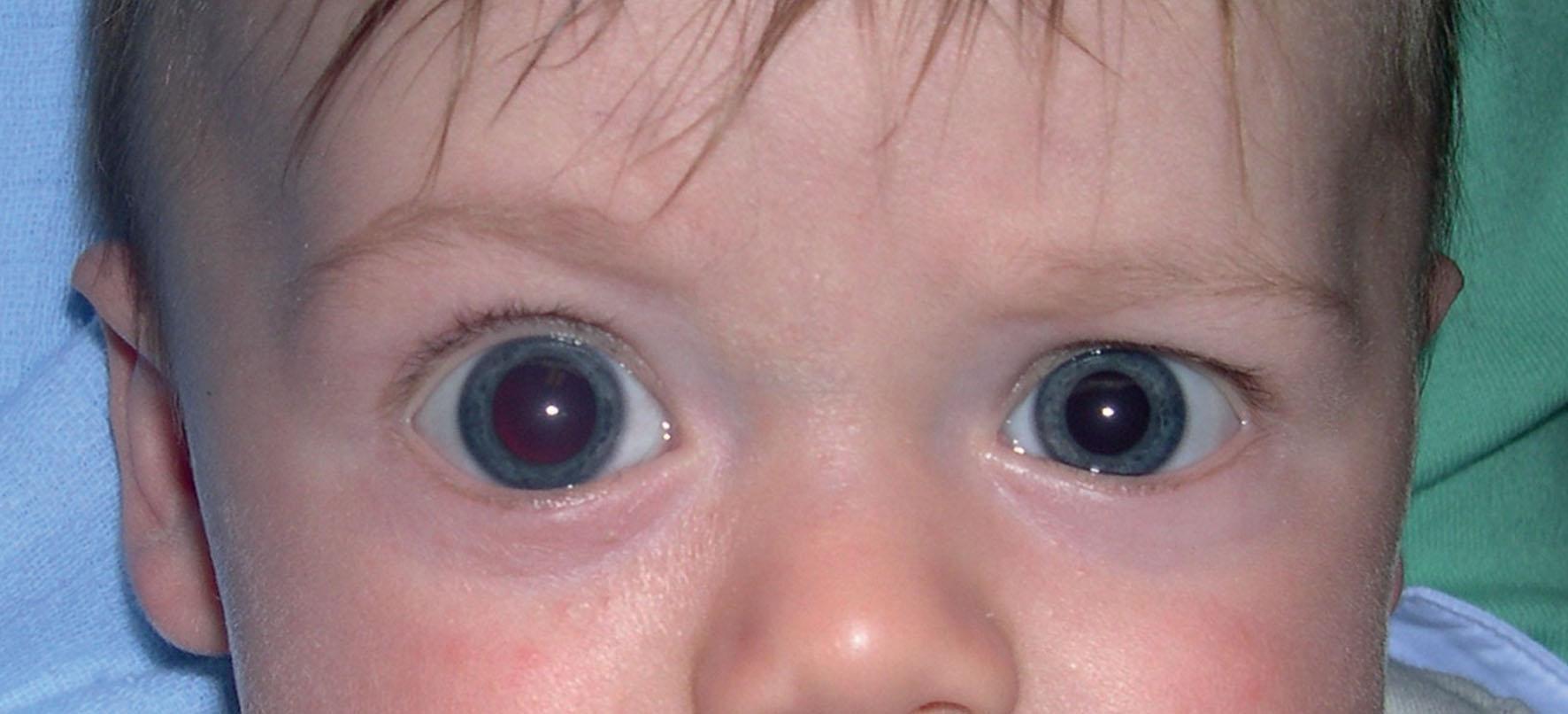 Fig. 36.1, Infant with right buphthalmos. The other eye often has similar features.