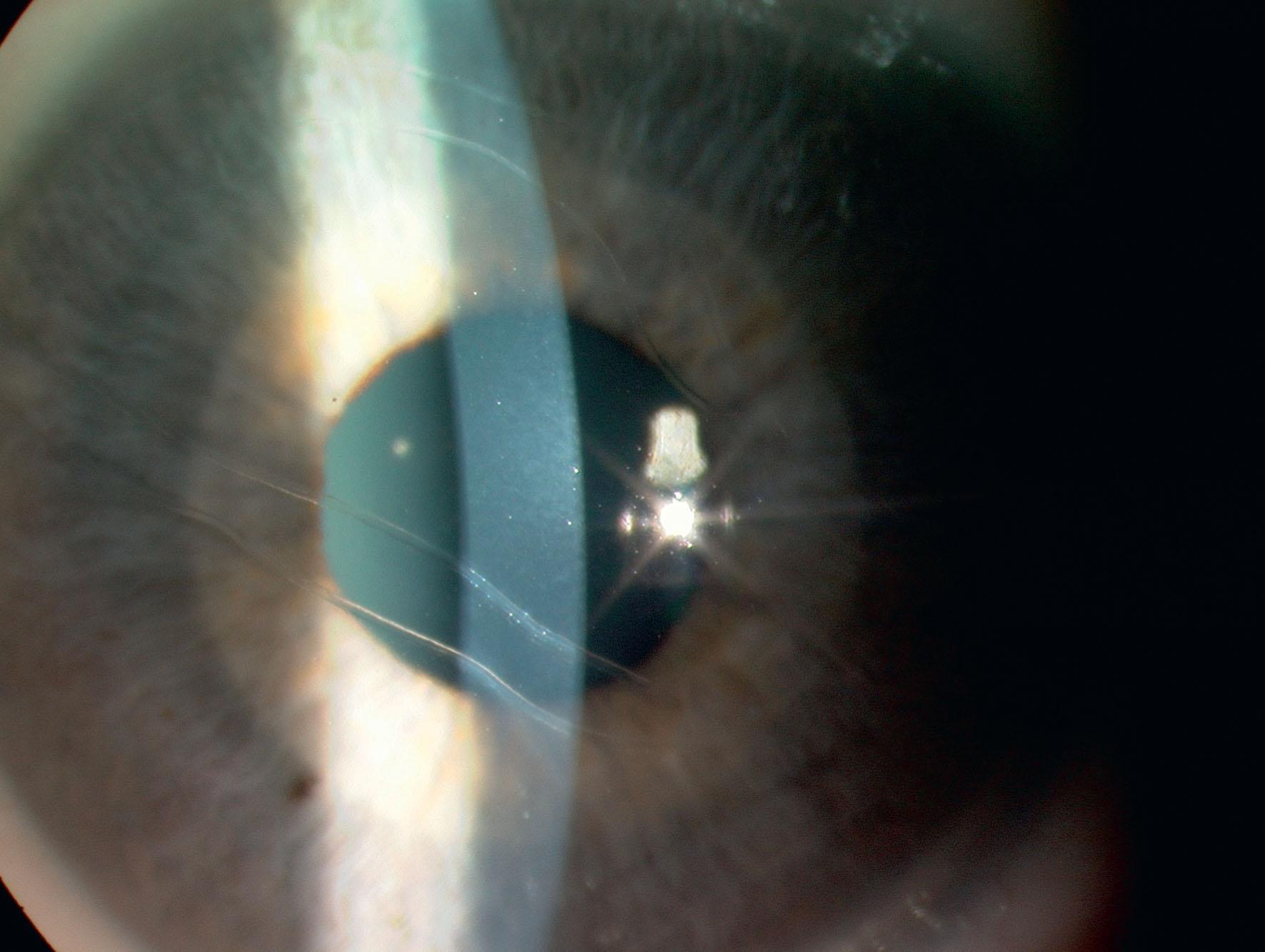 Fig. 36.2, Haab striae, pathognomonic of glaucoma in infancy in the presence of an enlarged cornea.