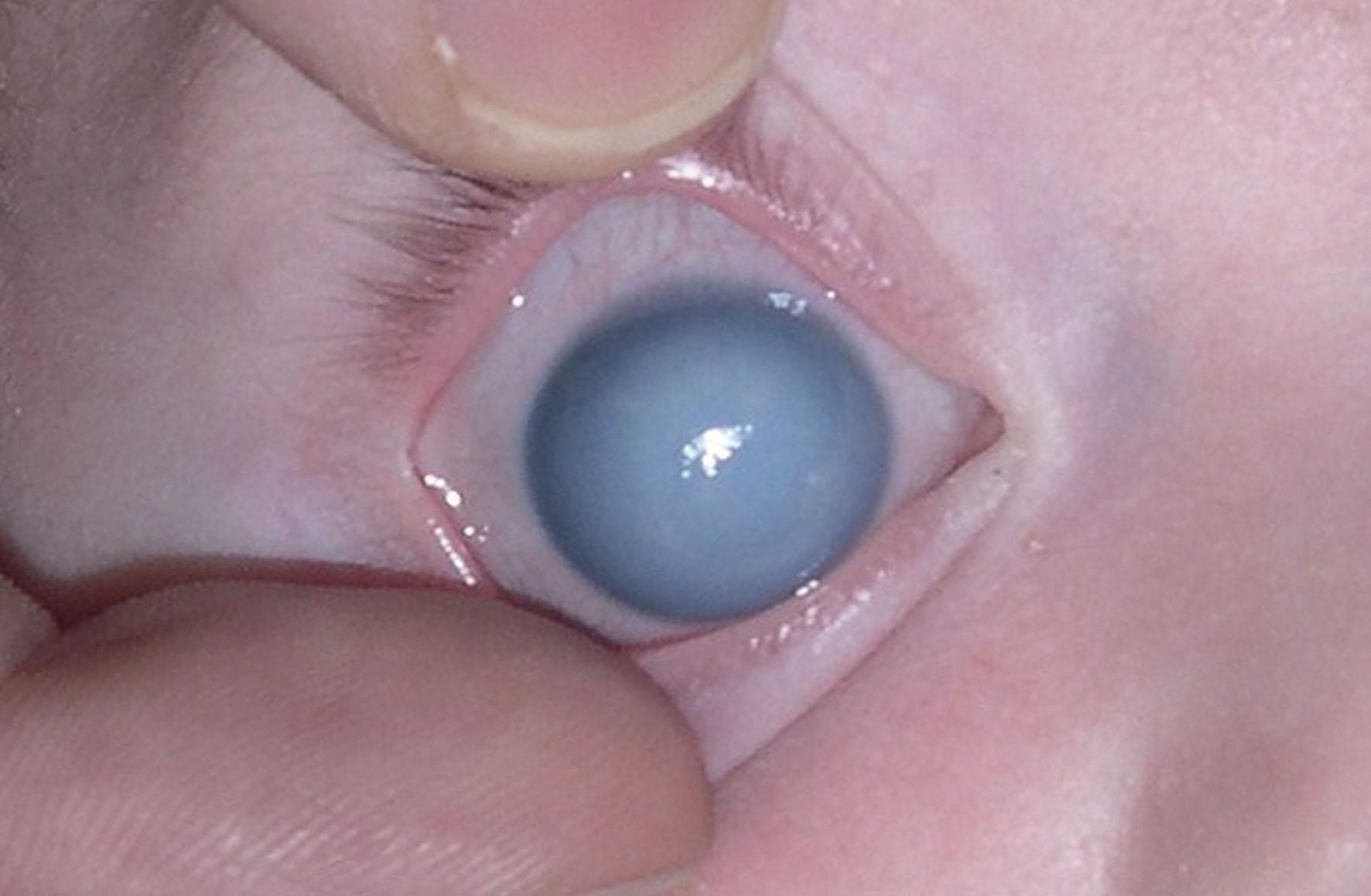 Fig. 36.4, Right corneal stromal edema from uncontrolled intraocular pressure before surgery.