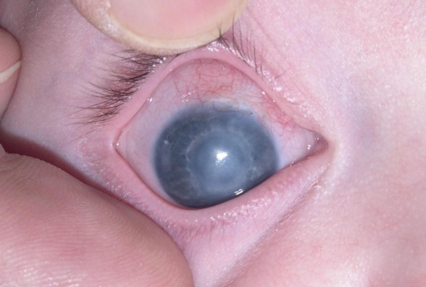 Fig. 36.5, Same eye with clearing of cornea edema following successful lowering of intraocular pressure with trabeculectomy.