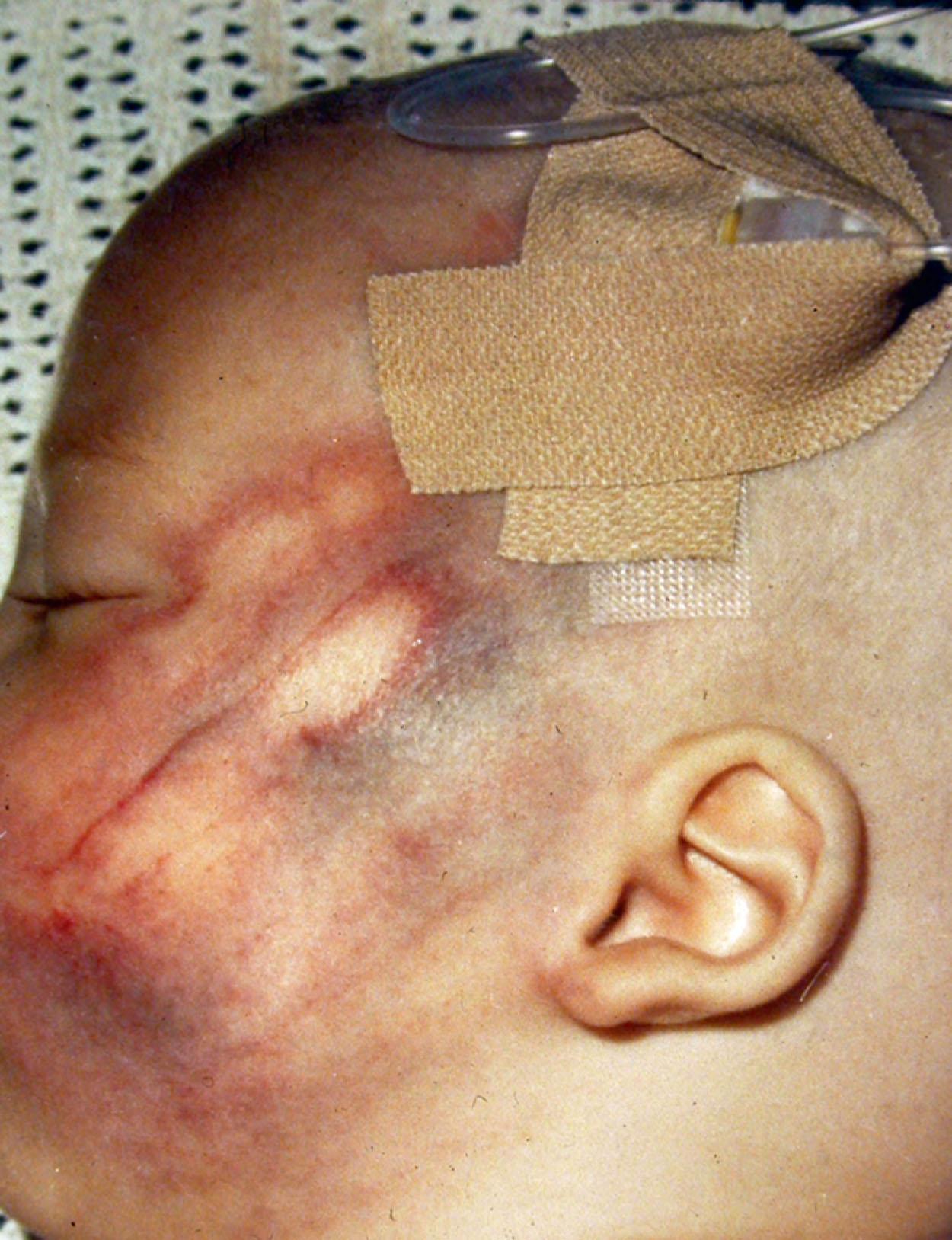 Fig. 71.1, An abusive bruise on the left cheek, demonstrating the imprint of fingers.