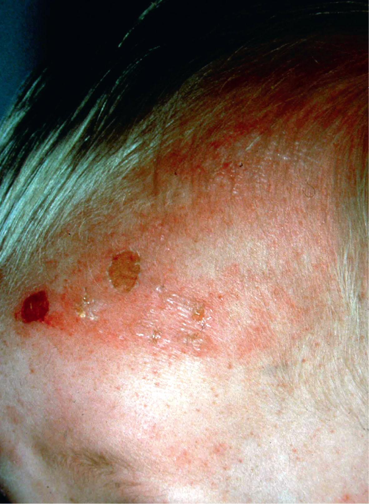 Fig. 71.3, Abusive cigarette burns on the left side of the forehead.