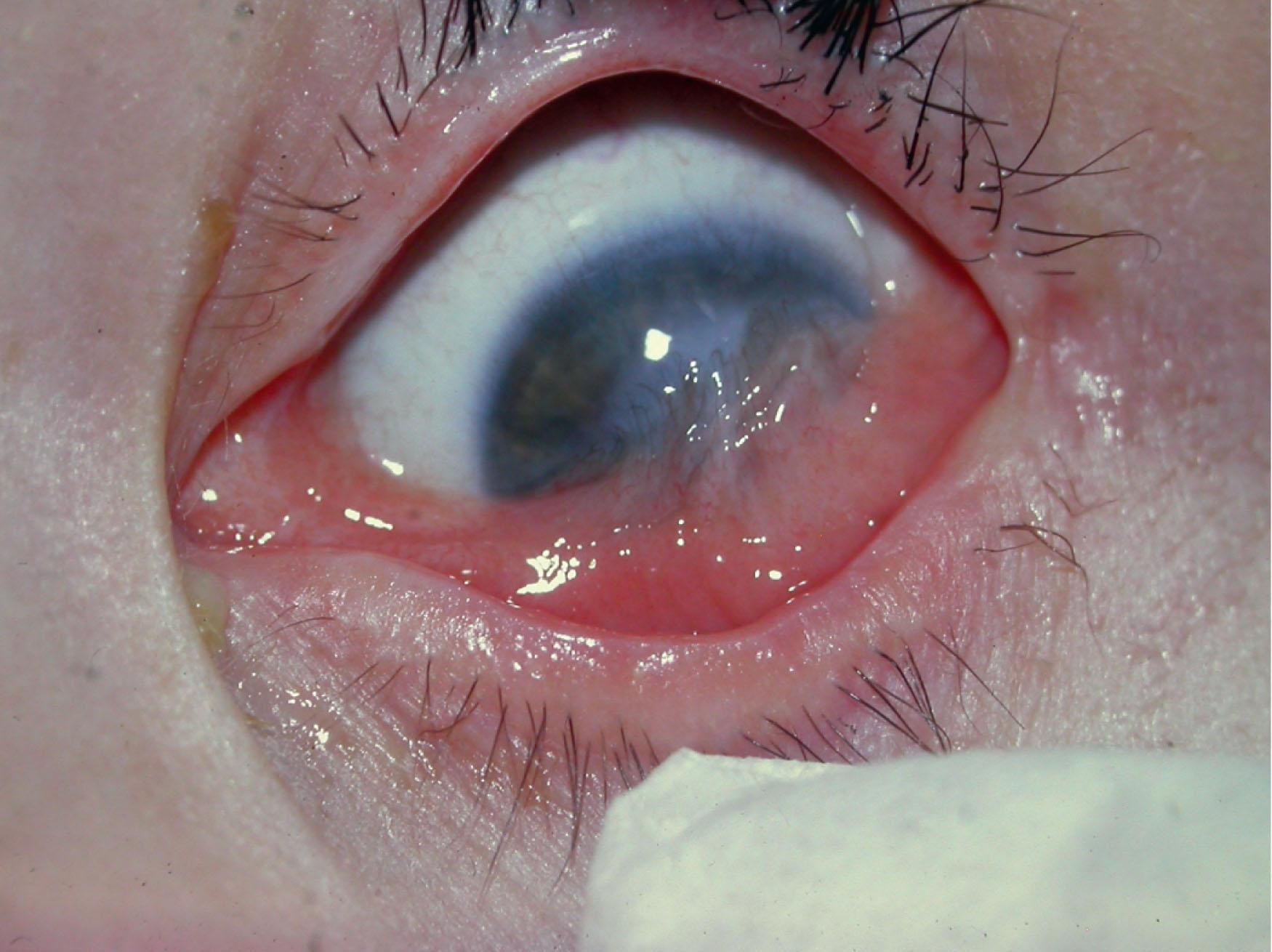 Fig. 71.5, Keratoconjunctivtis with vascularization and pseudo pterygium of the inferior cornea seen in a child from repeated toxin instillation by her caregiver.