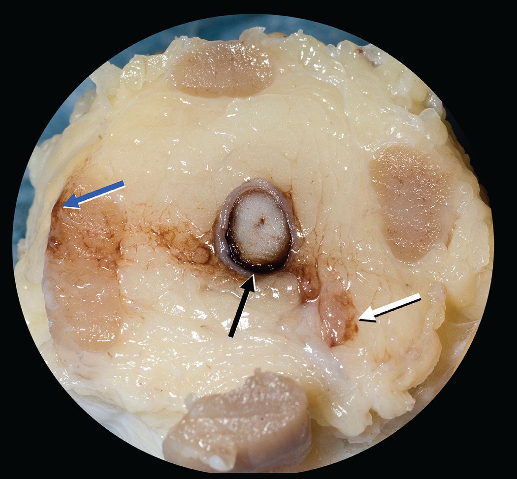 Fig. 71.6, Postmortem findings of hemorrhage within the optic nerve sheath (black arrow), orbital fat (white arrow), and muscle (blue arrow).