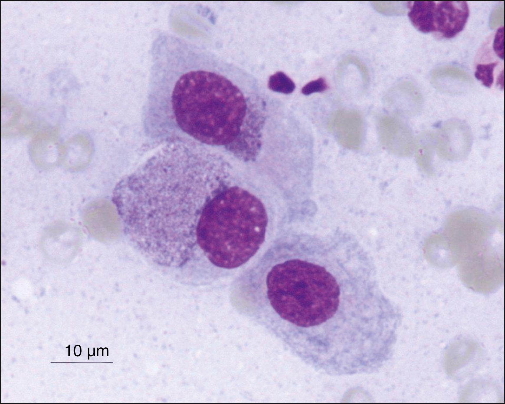 Fig. 39.1, Giemsa stain of conjunctival scraping showing two epithelial cells with a chlamydial cytoplasmic inclusion body (upper left) and one epithelial cell without an inclusion (lower right) ; 100× magnification.