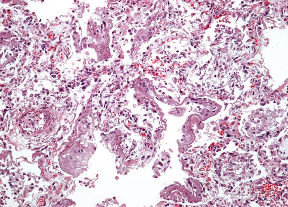 FIG. 15.1, Mycoplasma pneumonia. Although Mycoplasma infections usually involve the attachment of the bacteria to the epithelium of the airways, in this case of severe pneumonia, the lung shows diffuse alveolar damage with abundant hyaline membranes.