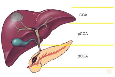 Fig. 47-1, The term cholangiocarcinoma (CCA) refers to tumors involving the entire biliary tree. Intrahepatic CCA denotes malignancies affecting the bile ducts inside the liver up to the second-degree bile ducts. Perihilar CCA extends from the second-degree bile ducts above the site of cystic duct insertion. Distal CCA extends distally from the site of cystic duct insertion to above the ampulla of Vater.