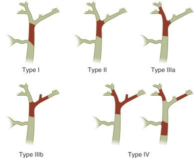 Fig. 47-3, The Bismuth-Corlette classification of perihilar cholangiocarcinoma (CCA).