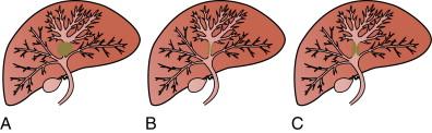 Figure 10-1, Schematic representation of the gross morphologic classification system for intrahepatic cholangiocarcinoma. (A) Mass forming. (B) Periductal infiltrating. (C) Intraductal growing.