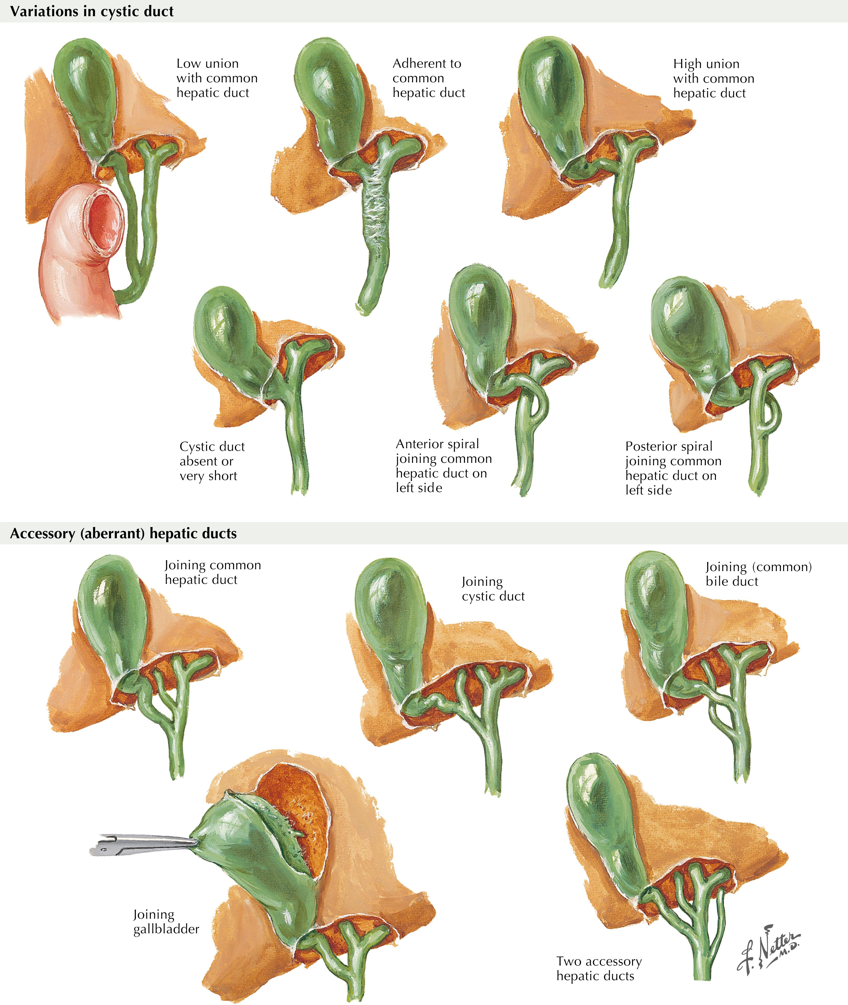 FIGURE 12.2, Variations in cystic and hepatic ducts.