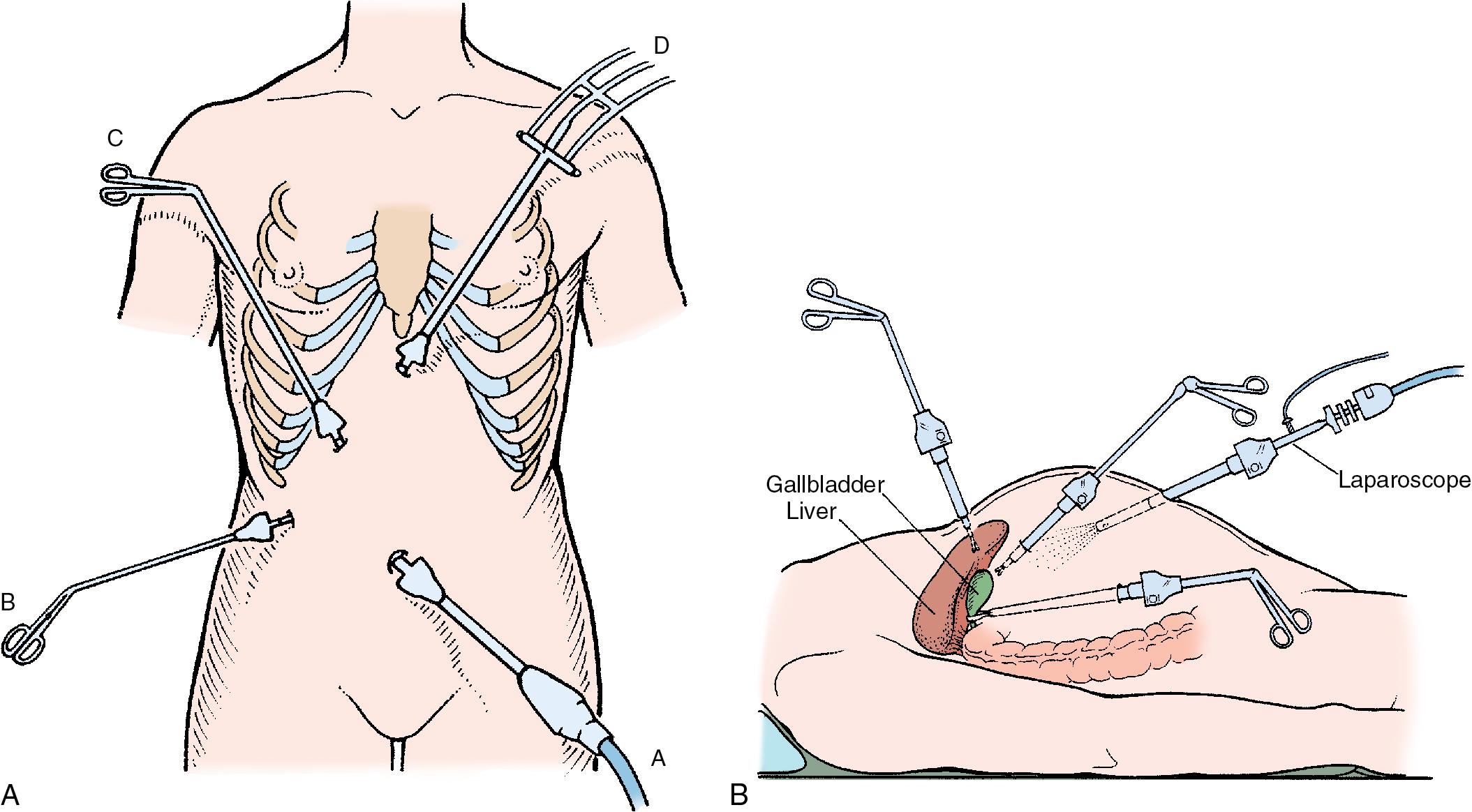 FIGURE 36.1, Positions for insertion of trocars during laparoscopic cholecystectomy. The laparoscope (A) is positioned in the periumbilical region, the graspers for gallbladder retraction (B) and manipulation (C) are positioned in the right upper quadrant (RUQ) along the subcostal region, and the subxyphoid region (D) is used for the dissector, diathermy, and clip appliers.