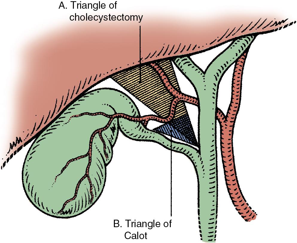 FIGURE 36.2, A, Triangle of cholecystectomy limited by the common hepatic duct, right hepatic duct, cystic duct, and inferior liver edge. B, The triangle of Calot limited by the common hepatic duct, cystic duct, and cystic artery.