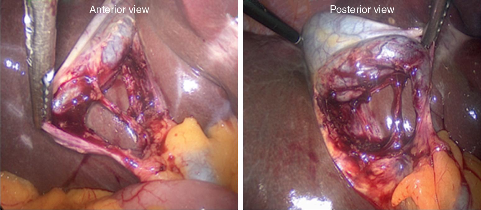 FIGURE 36.3, A , Critical view. Hepatocystic triangle is dissected free of all tissue except for the cystic duct and artery, and one-third of the cystic plate on the liver bed is exposed. When this view is achieved, the two structures entering the gallbladder can only be the cystic duct and artery. B , Critical view of safety during laparoscopic cholecystectomy.