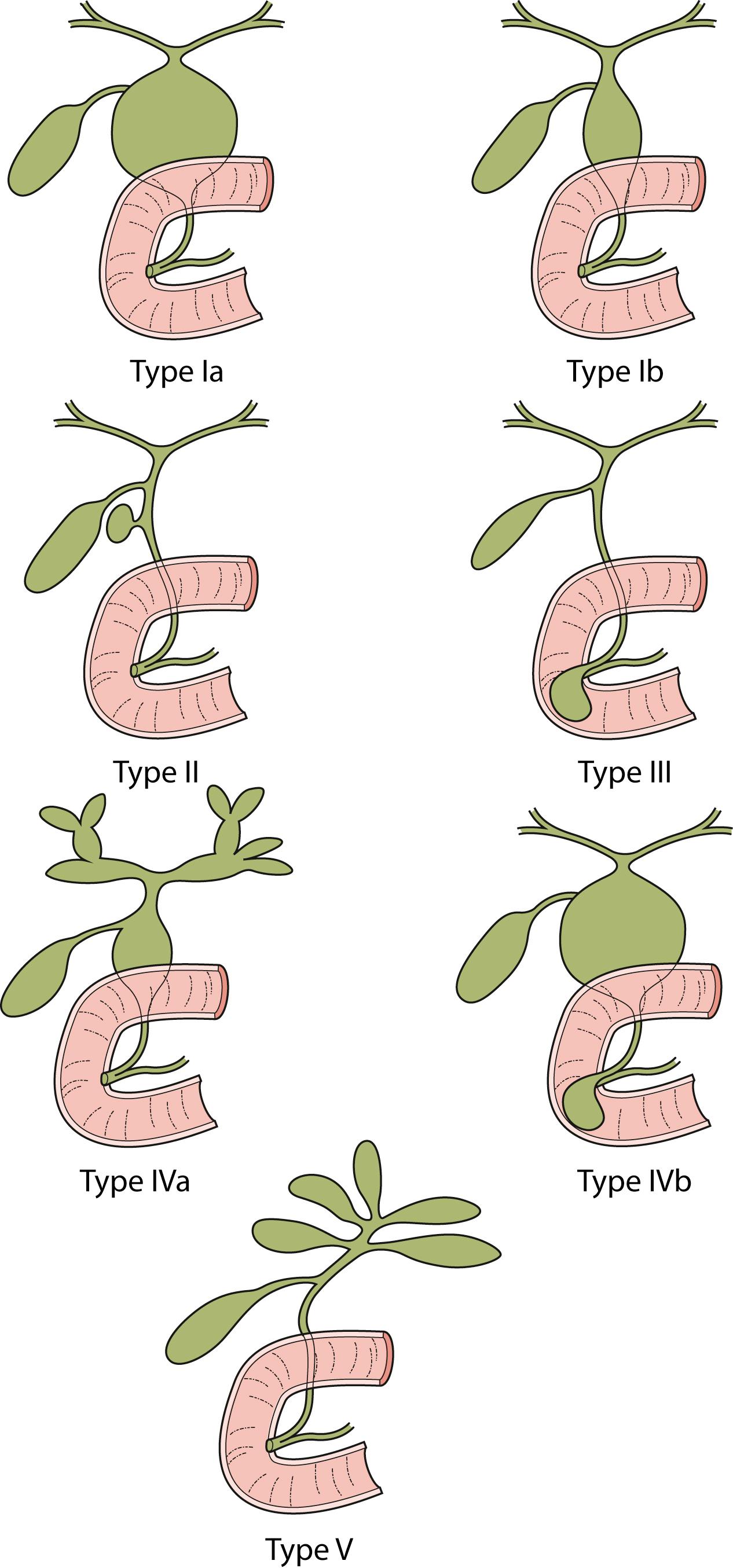 Fig. 44.1, These diagrams depict the five classifications for choledochal cyst according to Todani.