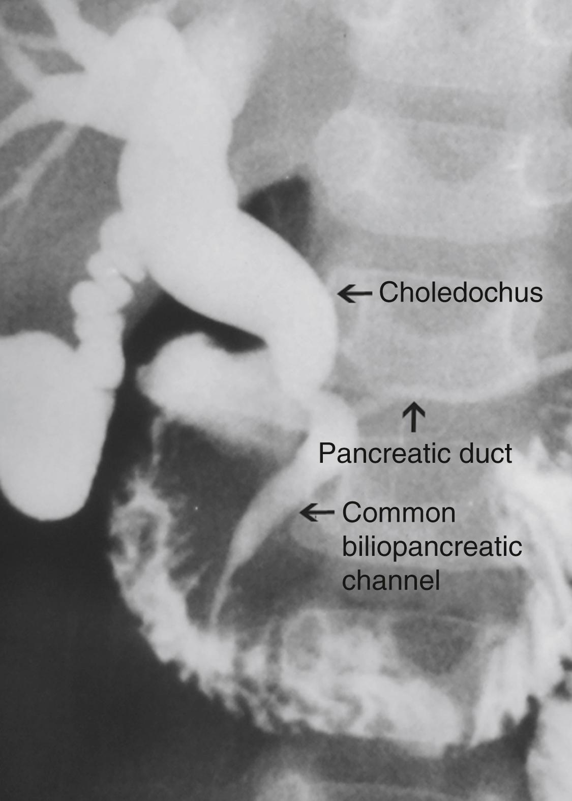 Fig. 44.2, This contrast study depicts a long common biliopancreatic channel that allows reflux of pancreatic secretions into the biliary tree. A long common biliopancreatic channel is thought to be the etiology of an acquired choledochal cyst.