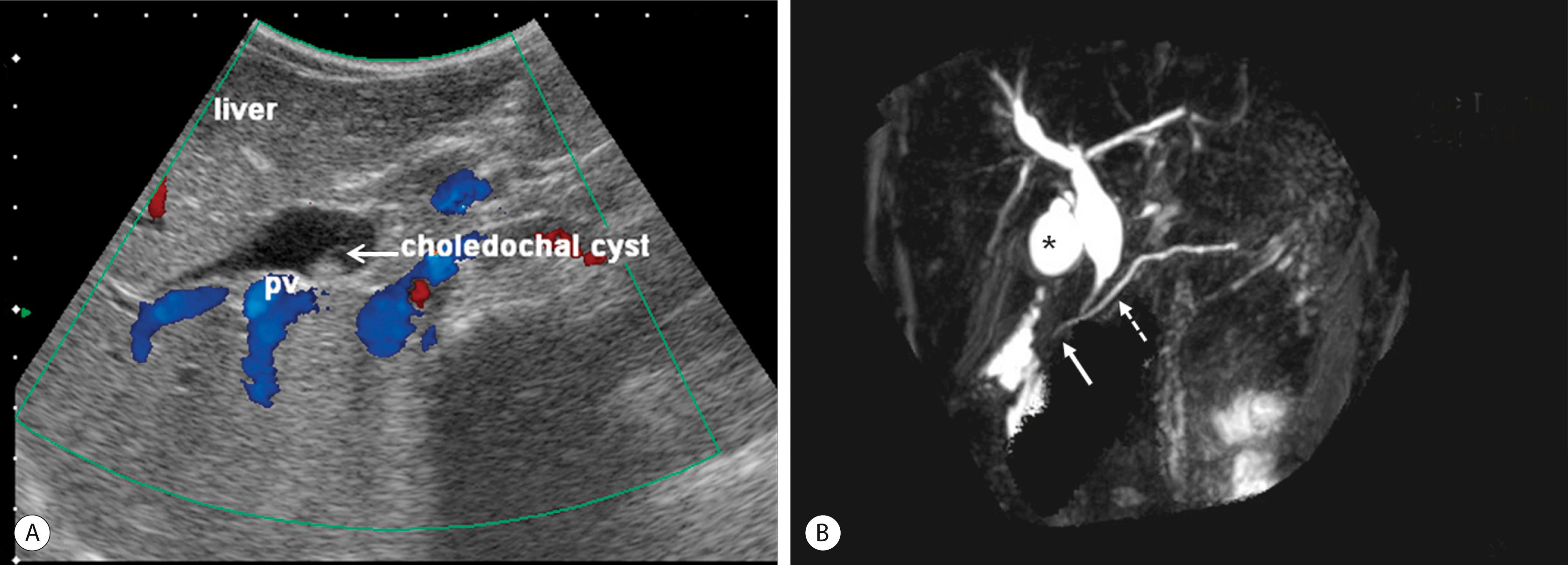 Fig. 44.3, (A) Ultrasound is the initial imaging method of choice for identifying a choledochal cyst. The cyst is identified as well as the portal vein (pv) lying posterior to it. (B) MRCP is highly accurate in the detection and classification of the cyst. On this MRCP image, note the fusiform choledochal cyst as well as the pancreatic duct (dotted arrow) and long common channel (solid arrow). The gallbladder is marked with an asterisk.