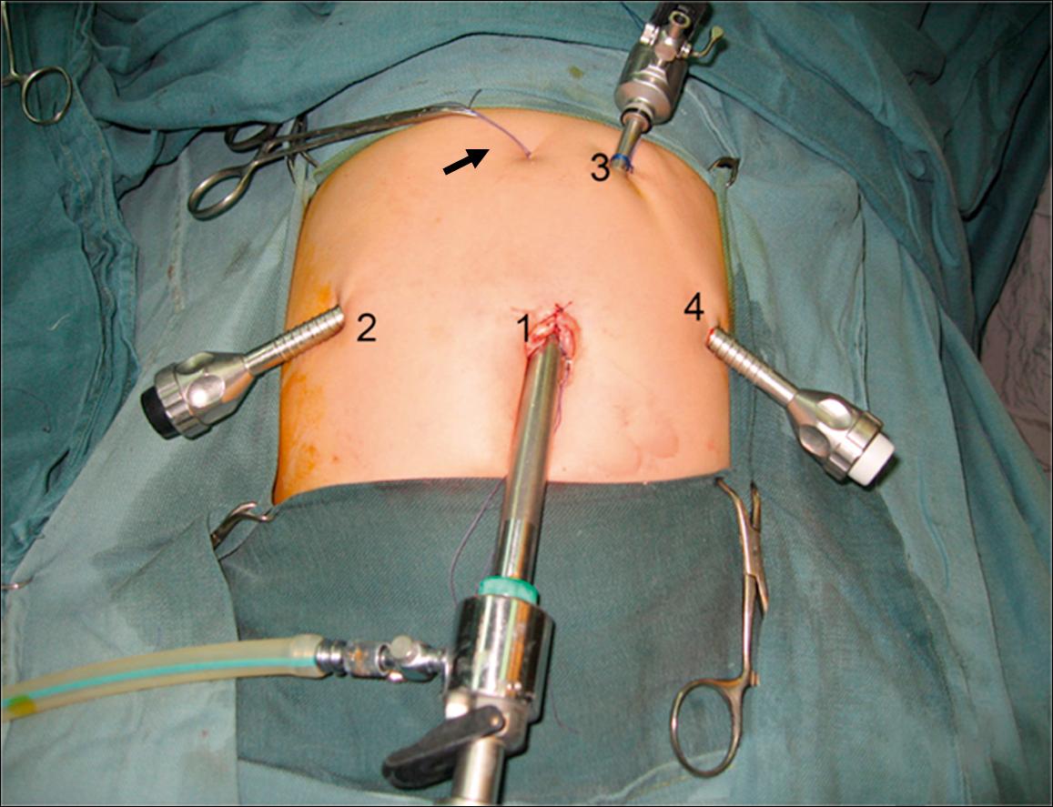 Fig. 44.6, This operative photograph depicts placement of the ports for laparoscopic repair of a choledochal cyst. A 10-mm cannula (1) is introduced through the umbilicus for the telescope. Three additional 5- or 3-mm ports are then used for the working instruments (2, 3, 4). Note that the liver has been elevated anteriorly with a suture placed around the round ligament and exteriorized in the epigastric region (arrow).