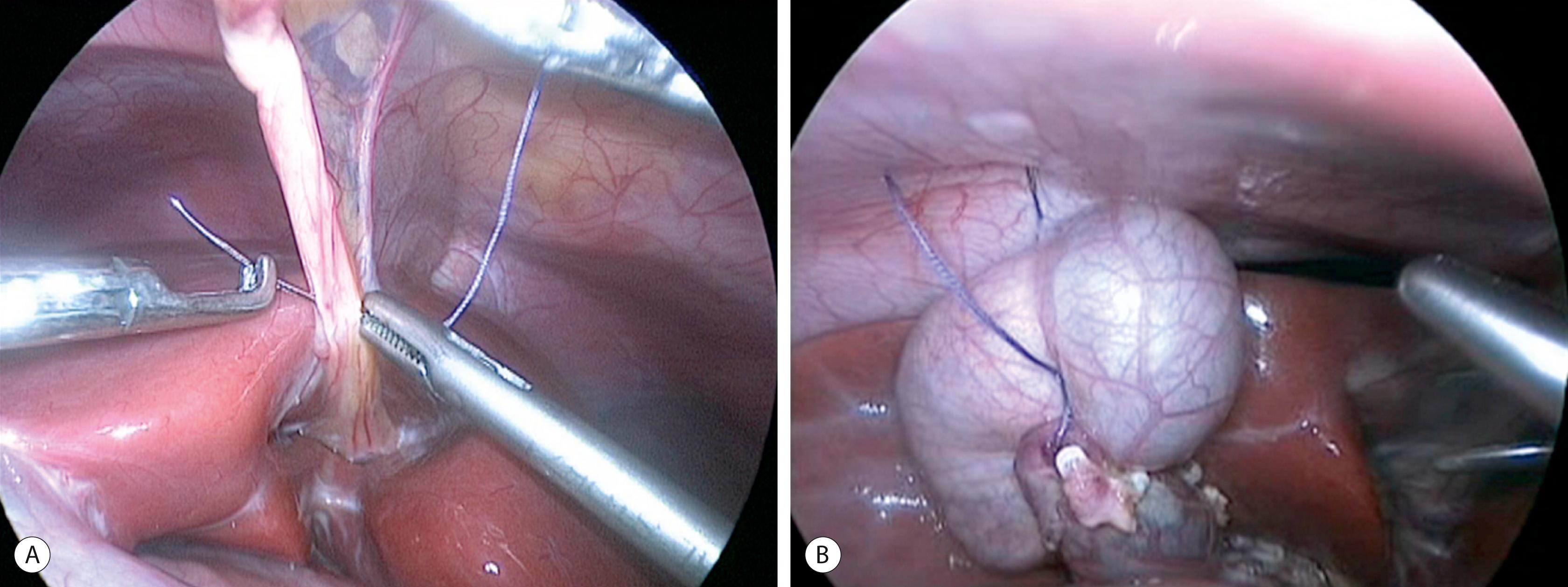 Fig. 44.7, (A) Suture has been placed through the round ligament and will be exteriorized in the epigastrium in order to help elevate the liver for exposure of the choledochal cyst. (B) A second traction suture has been positioned at the junction of the distal cystic duct and gallbladder fundus to further elevate the liver anteriorly and expose the hepatic hilum.