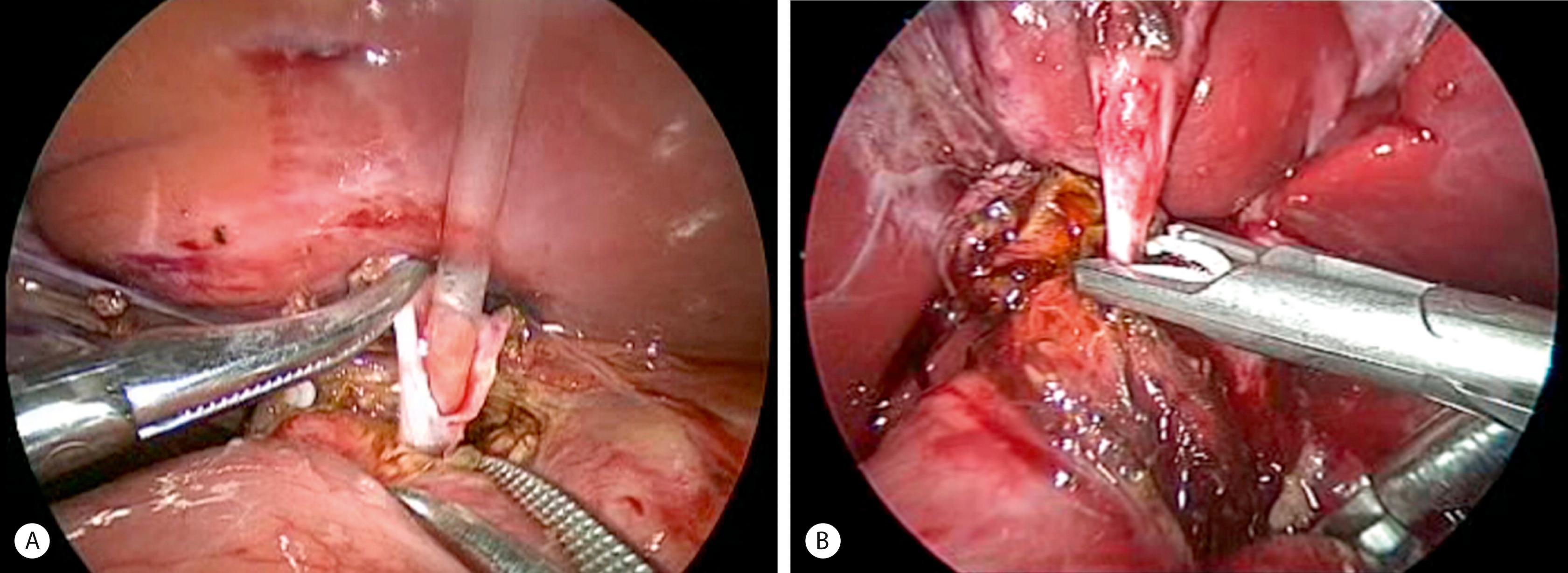 Fig. 44.8, (A) After opening the inferior part of the cyst to identify the orifice of the common biliopancreatic channel, a small catheter is inserted into the common channel for irrigation and elimination of protein plugs. (B) After the common channel has been irrigated, the distal choledochal cyst is being ligated with an endoscopic clip and will subsequently be divided at the level of the orifice of the common channel