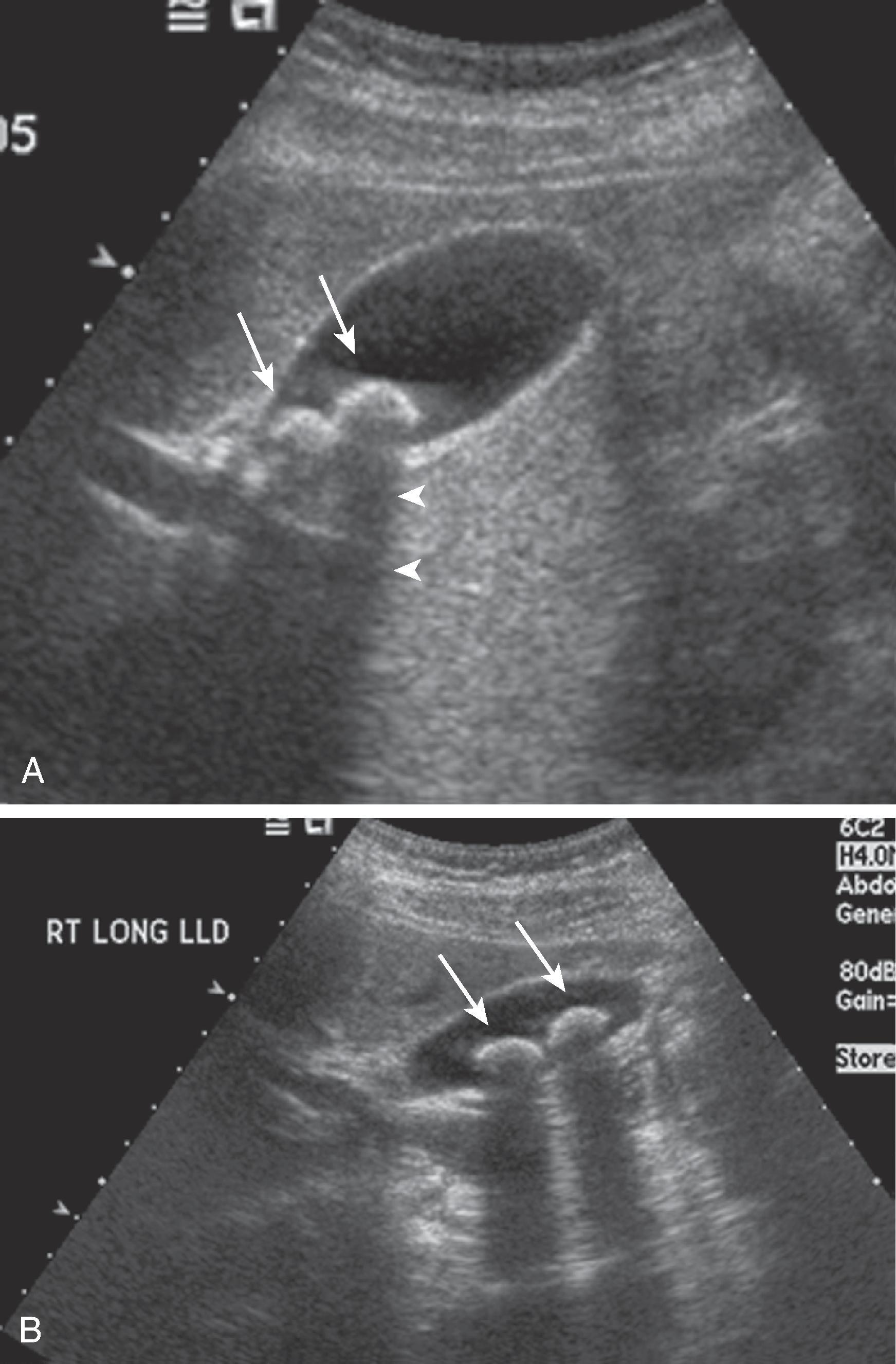 Fig. 49.1, Gallstones: sonography. (A) Two highly reflective echoes (arrows) are located in the dependent portion of the gallbladder lumen with posterior acoustic shadowing (arrowheads) . (B) When the patient is imaged in the left lateral decubitus position (LLD) , the gallstones (arrows) change location, indicating mobility.