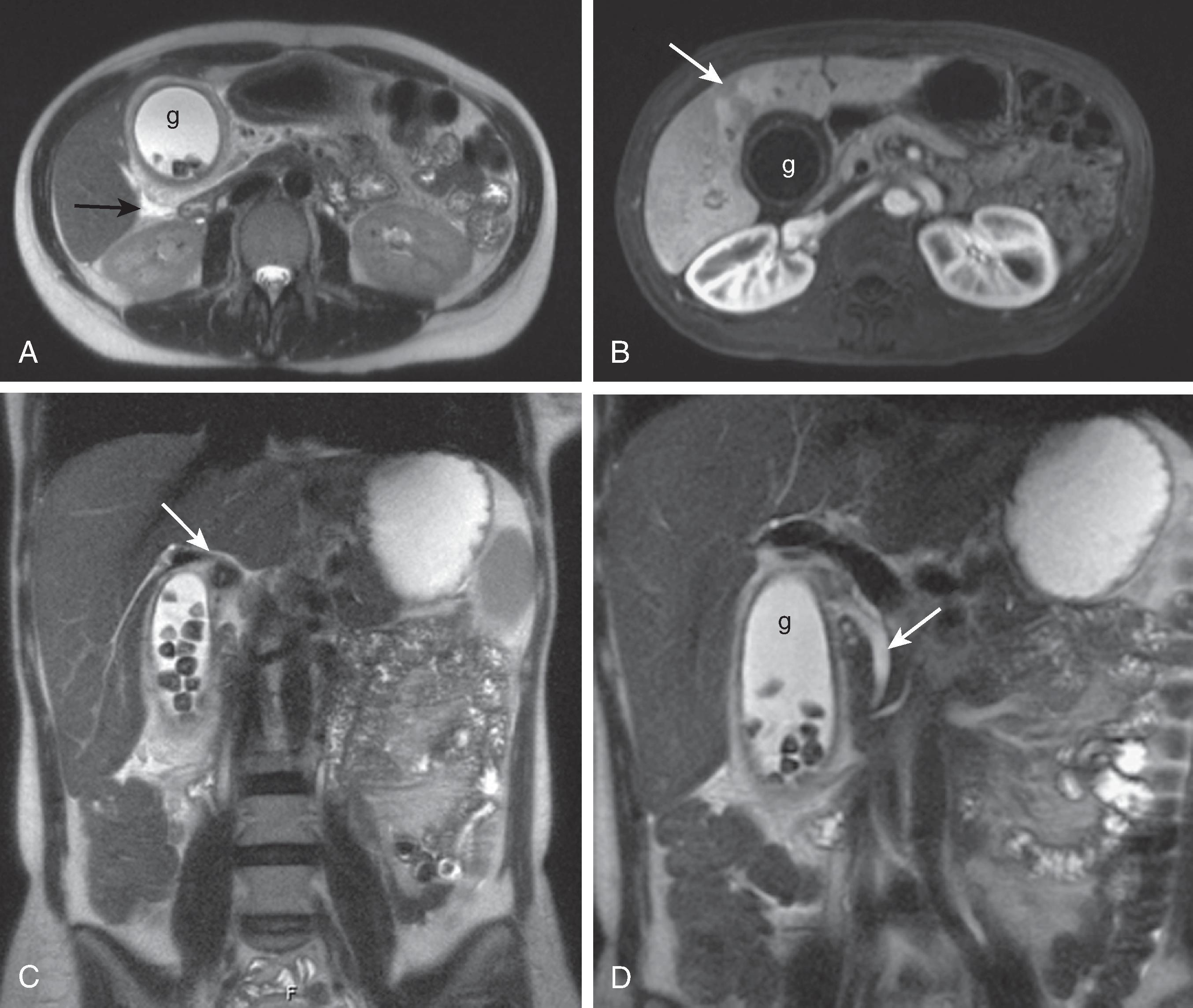 Fig. 49.13, Acute cholecystitis: magnetic resonance findings. (A) T2-weighted half-Fourier acquisition single-shot turbo spin-echo (HASTE) image demonstrates gallbladder distention (g) . Dependent low signal gallstones are evident. Gallbladder wall is thickened, and there is pericholecystic fluid (arrow) . (B) Contrast-enhanced T1-weighted gradient-echo fat-suppressed image demonstrates gallbladder distention (g) with wall thickening. Increased enhancement is present in adjacent liver parenchyma (arrow) . (C) Coronal HASTE image demonstrates distended gallbladder with multiple stones. Arrow points to stone in the gallbladder neck. (D) Coronal HASTE image demonstrates normal common bile duct (arrow) .