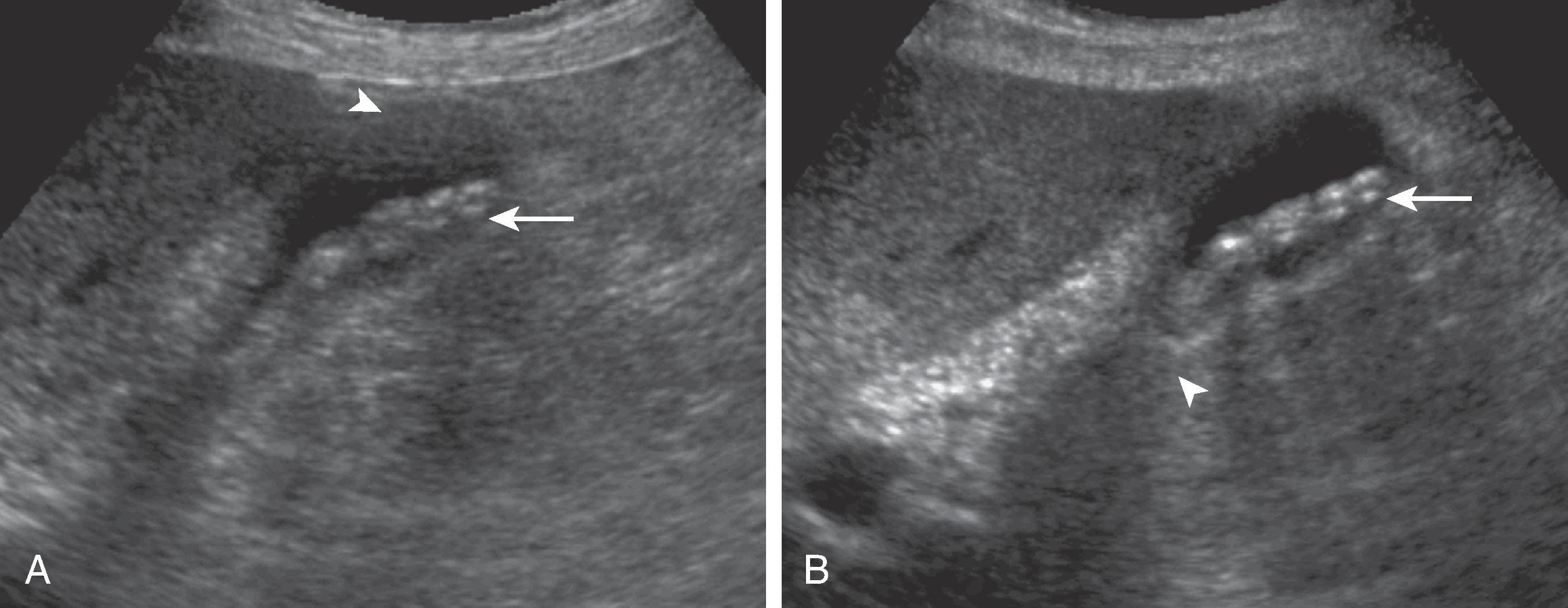 Fig. 49.3, Gallstones: improved sonographic visualization with tissue harmonic imaging. (A) Image obtained with 4-MHz transducer demonstrates gallstones (arrow) . Near-field echoes (arrowhead) correspond to reverberation artifact. (B) Image obtained with tissue harmonic imaging eliminates reverberation artifact. Gallstones are better delineated (arrow) , and posterior acoustic enhancement is more evident (arrowhead)