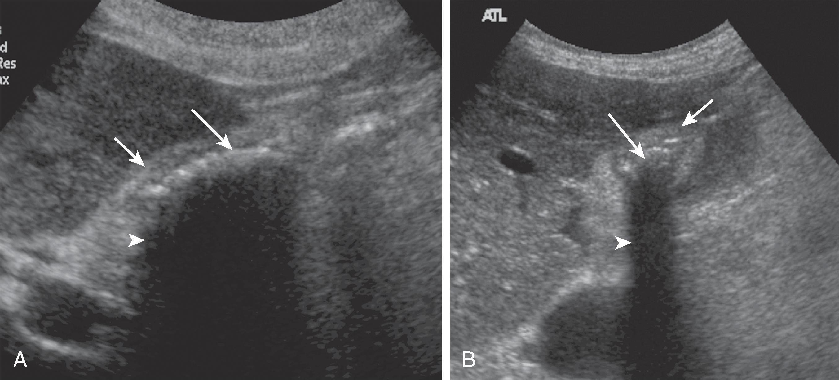 Fig. 49.4, Wall-echo-shadow sign on ultrasound. Multiple gallstones are present within a contracted gallbladder. (A) Sagittal and (B) transverse views. Short arrow points to gallbladder wall that appears as an echogenic arc. Long arrow points to gallstones that appear as bright echoes. The arrowhead points to posterior acoustic shadowing.