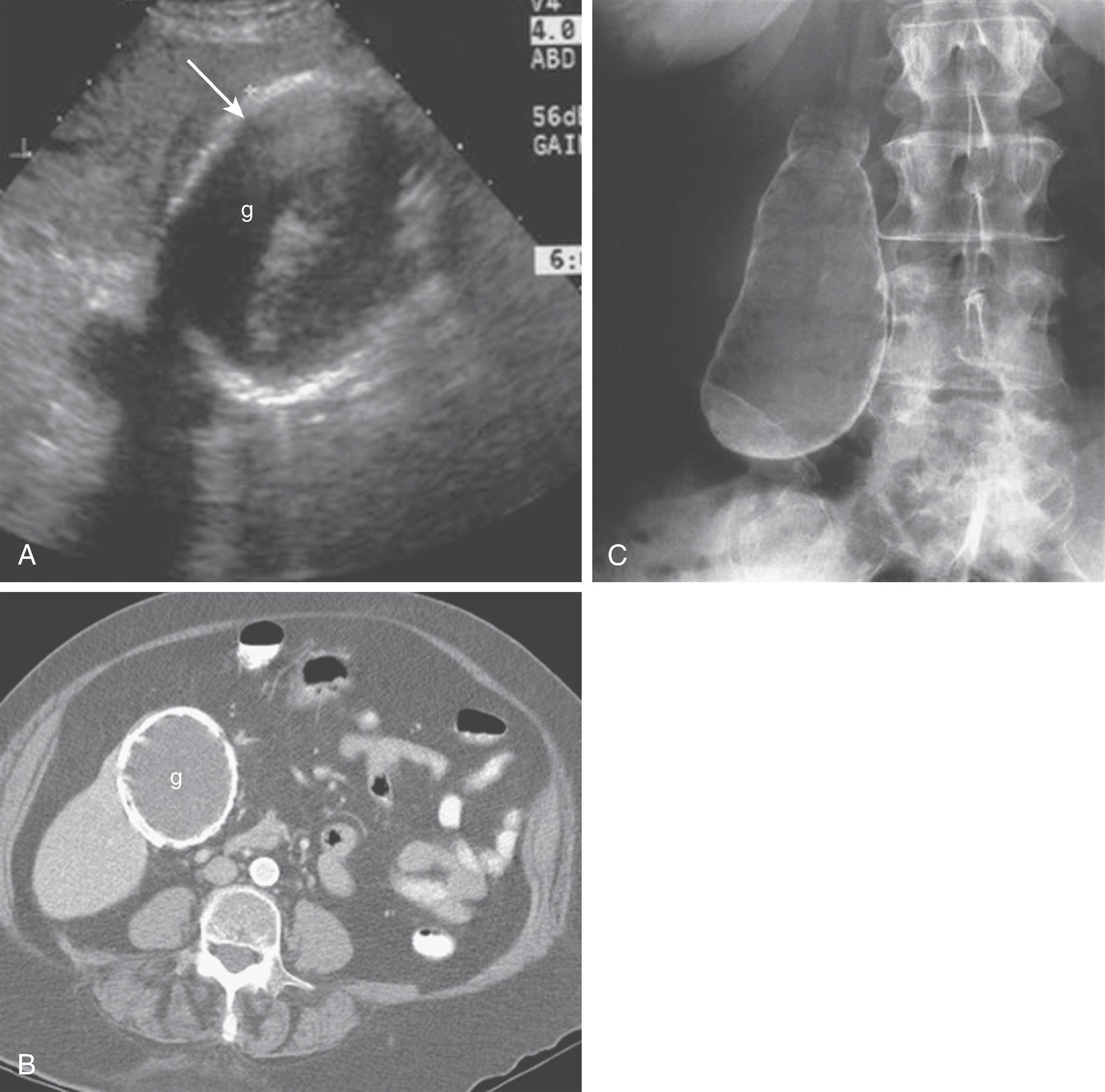 Fig. 49.5, Porcelain gallbladder: imaging features. (A) Ultrasound demonstrates increased echogenicity of the wall (arrow) of the gallbladder (g) . (B) Computed tomography scan shows concentric mural calcification of the gallbladder (g) , confirming porcelain gallbladder. (C) Abdominal radiograph shows concentric mural calcification.