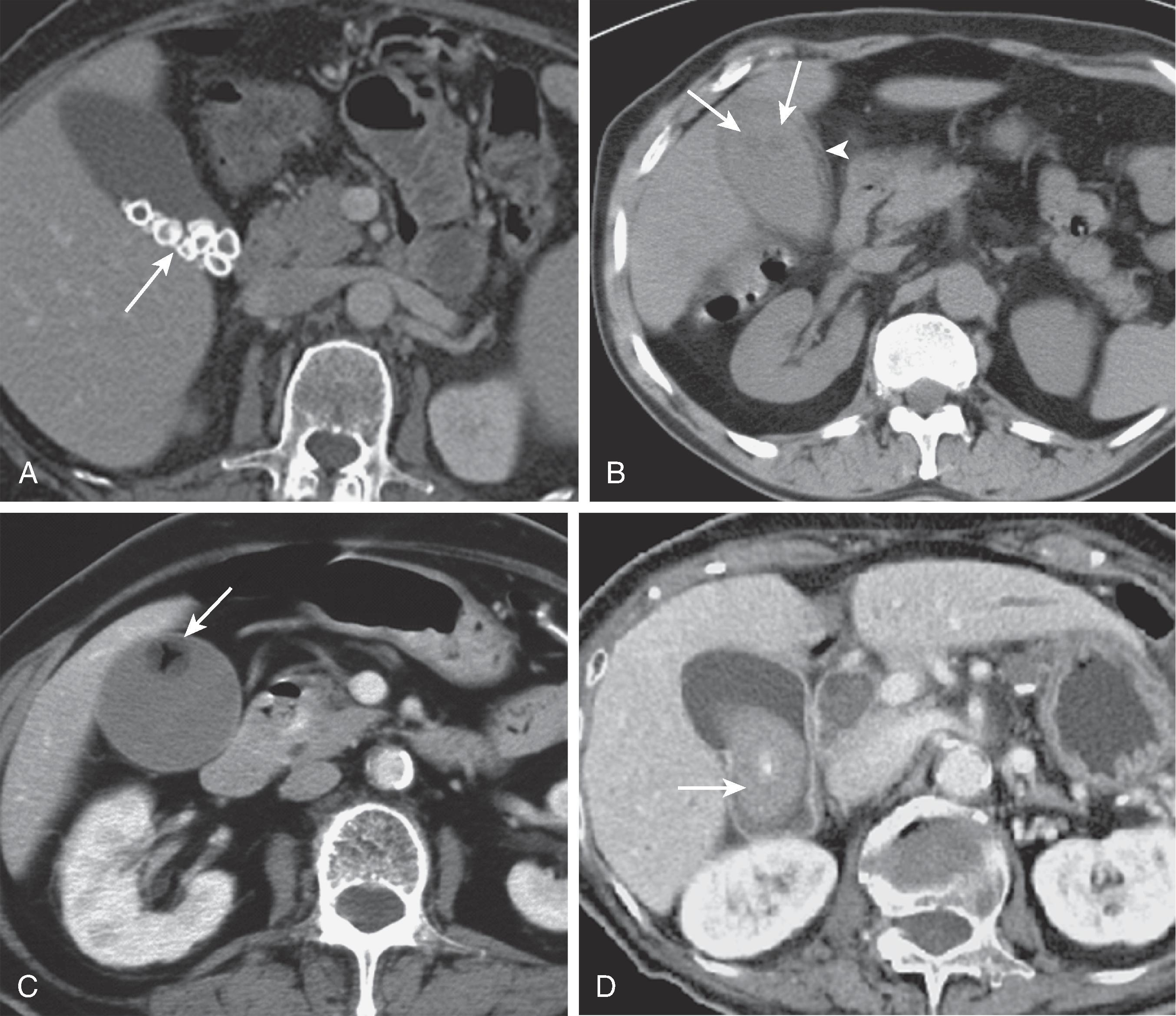 Fig. 49.6, Computed tomography appearance of gallstones. (A) Calcified stones depicted as calcified dependent densities in the gallbladder lumen (arrow) . (B) Noncalcified stones may be visible if they are less dense than bile (arrows) . This patient also had acute cholecystitis. Note thickened gallbladder wall (arrowhead) . (C) Mercedes-Benz sign. Gas-containing stone floating in bile (arrow) . (D) Pigment stone (arrow) is soft tissue density with only small central nidus of calcification.