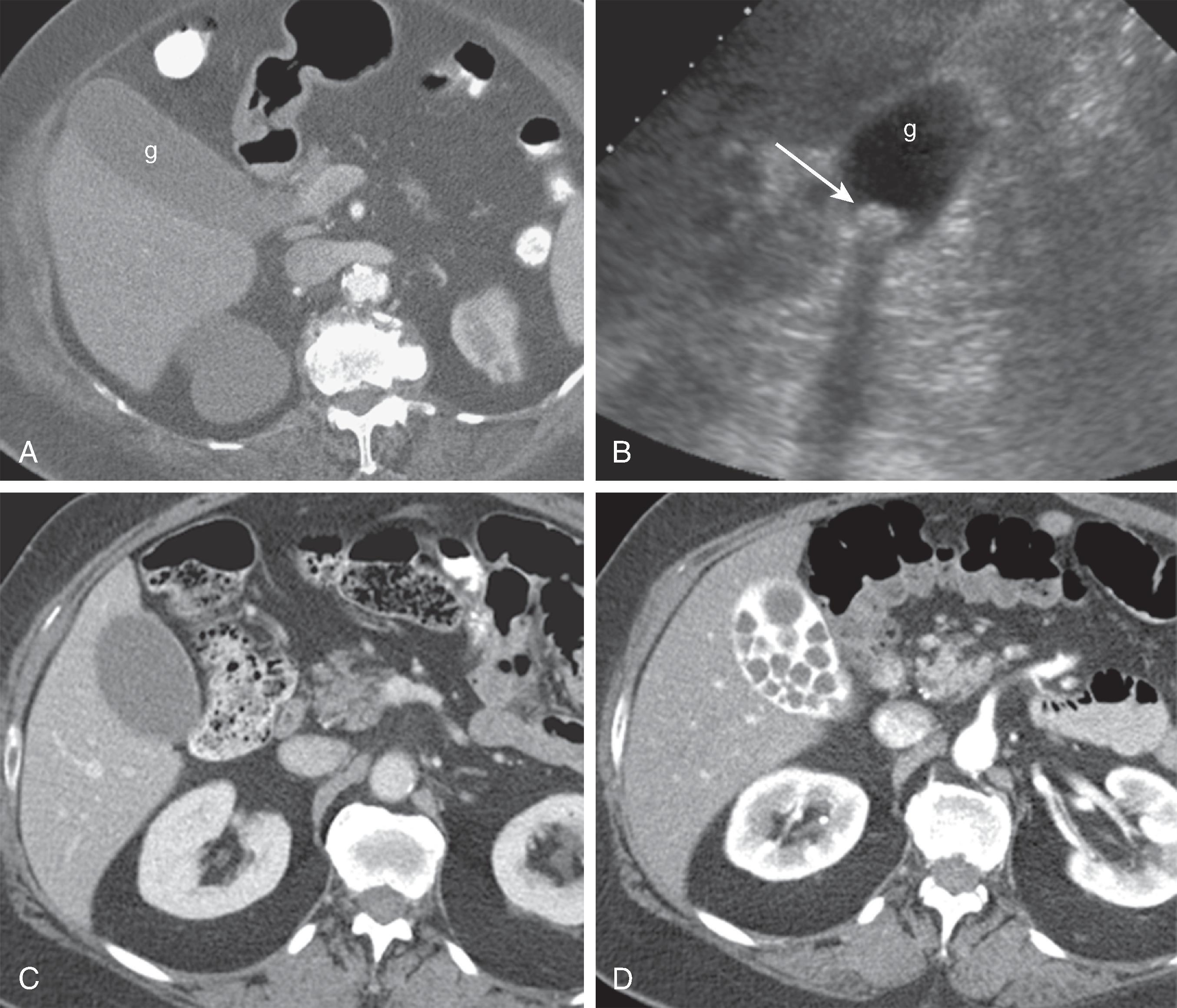 Fig. 49.7, Noncalcified gallstones not visualized at computed tomography (CT). (A) CT scan demonstrates no stones in the gallbladder (g) . (B) Ultrasound performed immediately after CT demonstrates shadowing stone (arrow) in the gallbladder (g) lumen. (C) CT scan in a different patient demonstrates no stones in the gallbladder. (D) CT performed several days later in the same patient now demonstrates multiple stones in the gallbladder because of vicarious excretion of previously administered intravenous contrast material in the gallbladder.