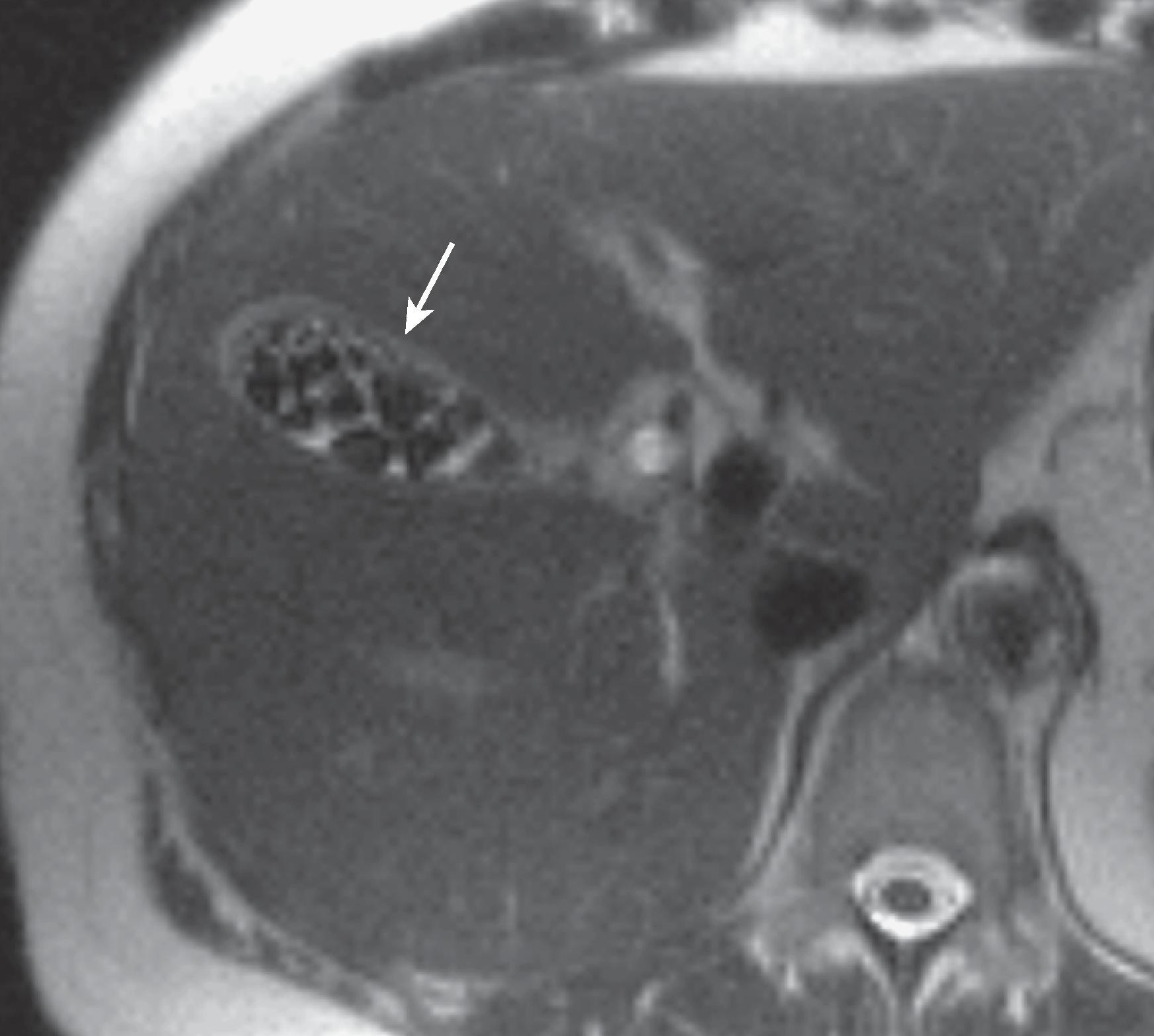 Fig. 49.8, Magnetic resonance imaging appearance of gallstones. Axial T2-weighted HASTE image demonstrates multiple low signal intensity filling defects in the gallbladder lumen (arrow) .