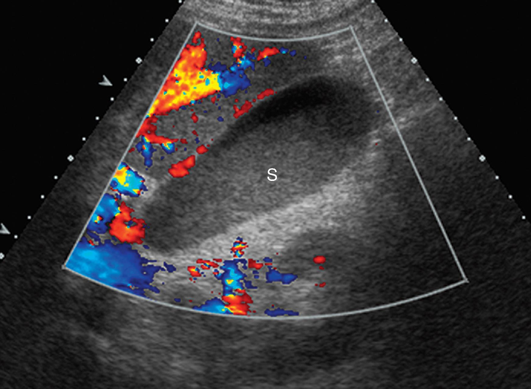 Fig. 49.9, Sludge: sonographic findings. Color Doppler shows no vascularity in sludge (s) , helping to exclude a solid, intraluminal mass.